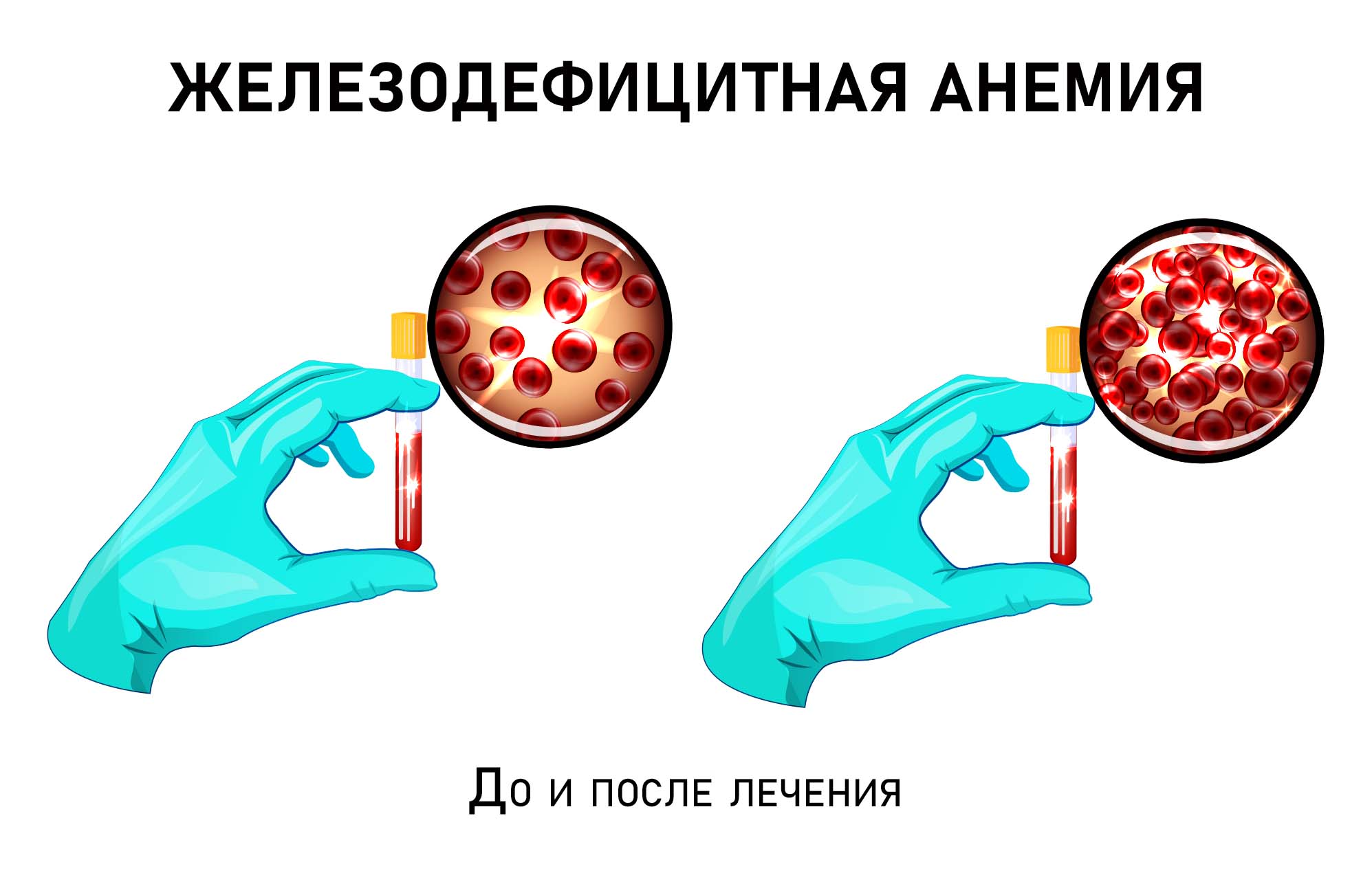 Железодефицитная анемия