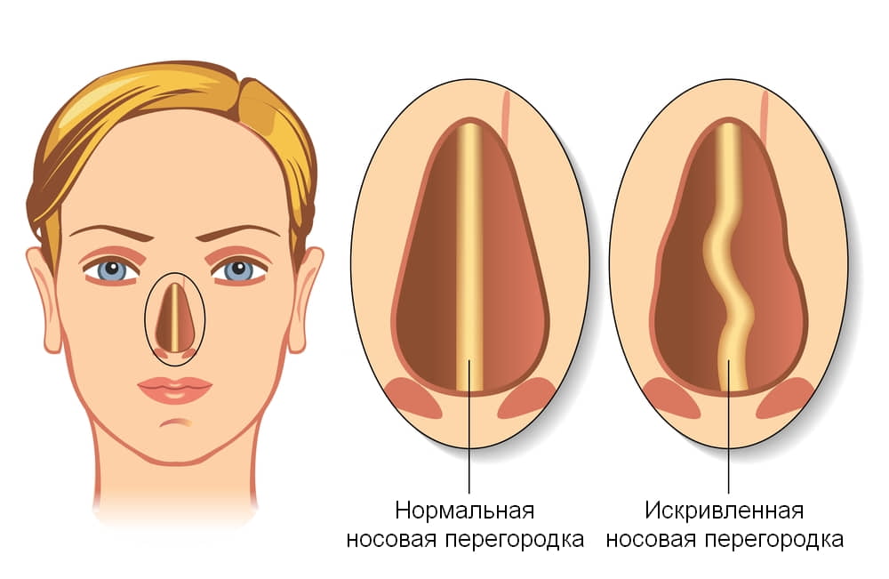 Коррекция искривления носовой перегородки