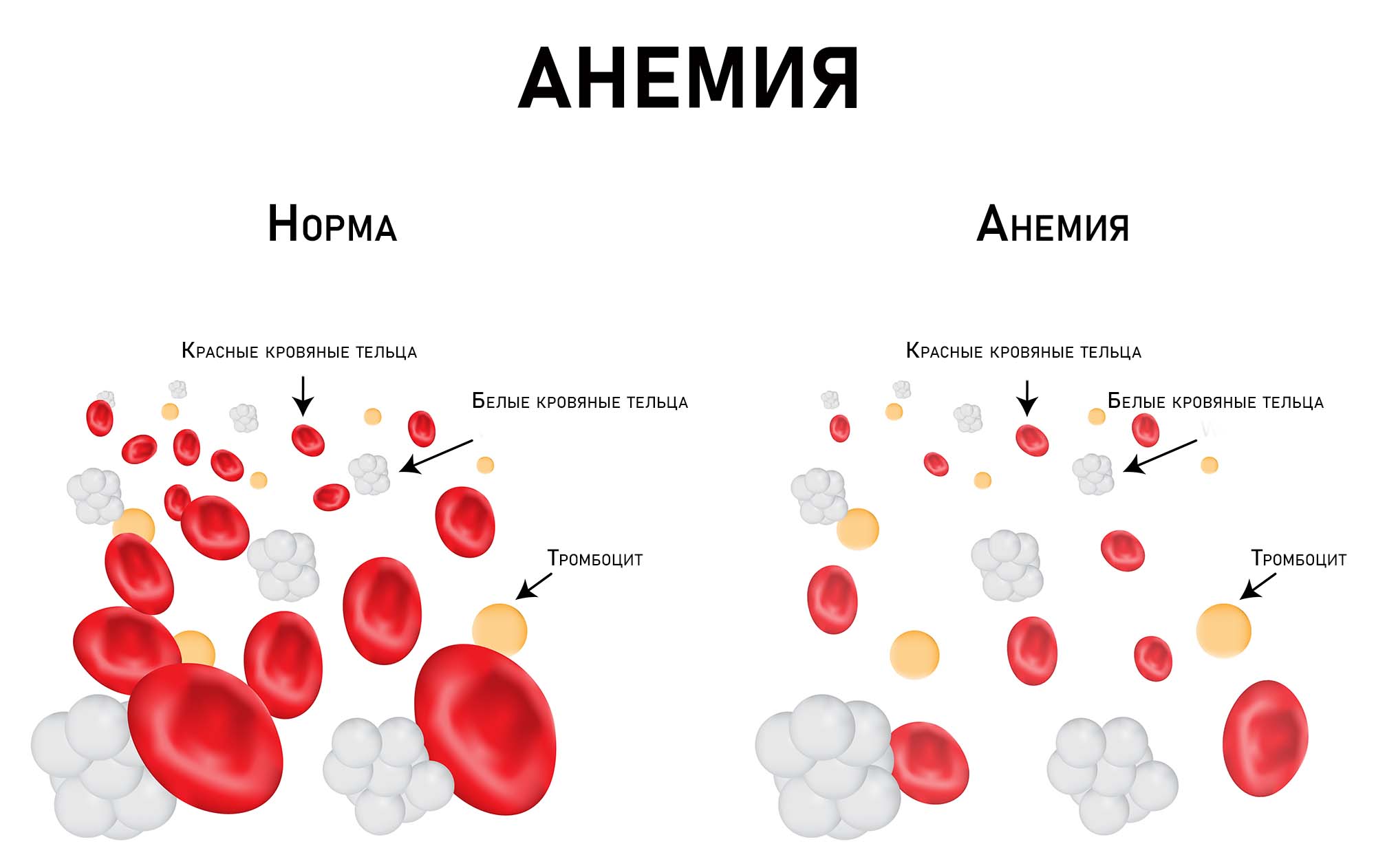 Анемия у пожилых людей