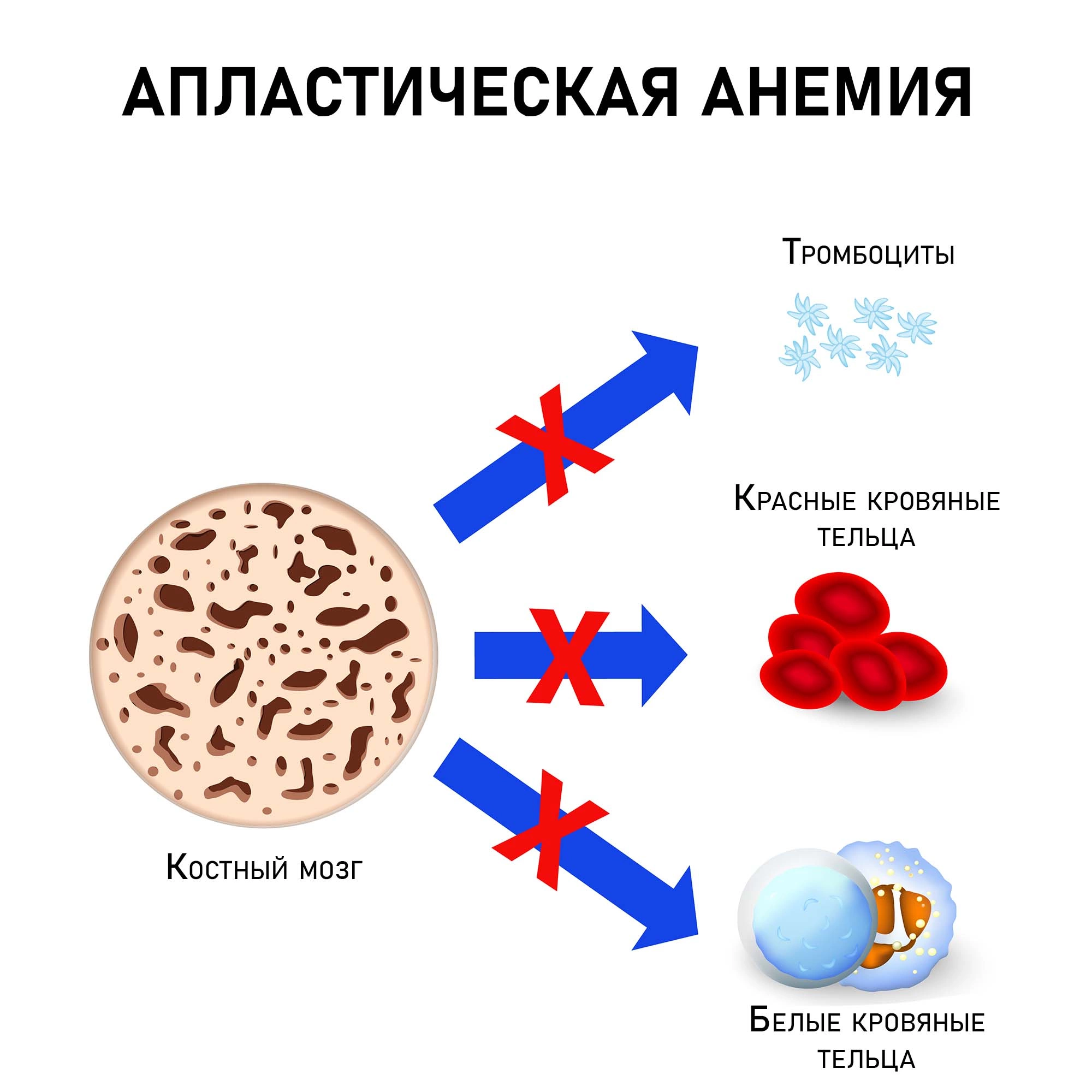 Апластическая анемия: причины, симптомы, классификация, диагностика, лечение