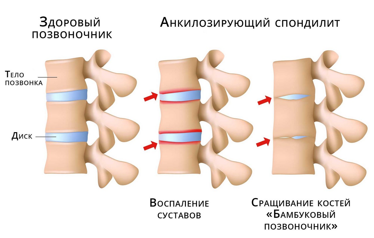 Болезнь Бехтерева
