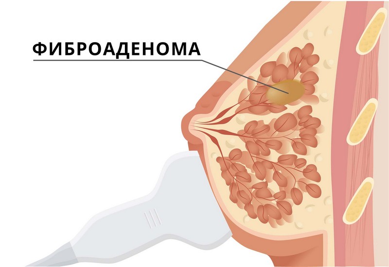 Фиброаденома молочной железы