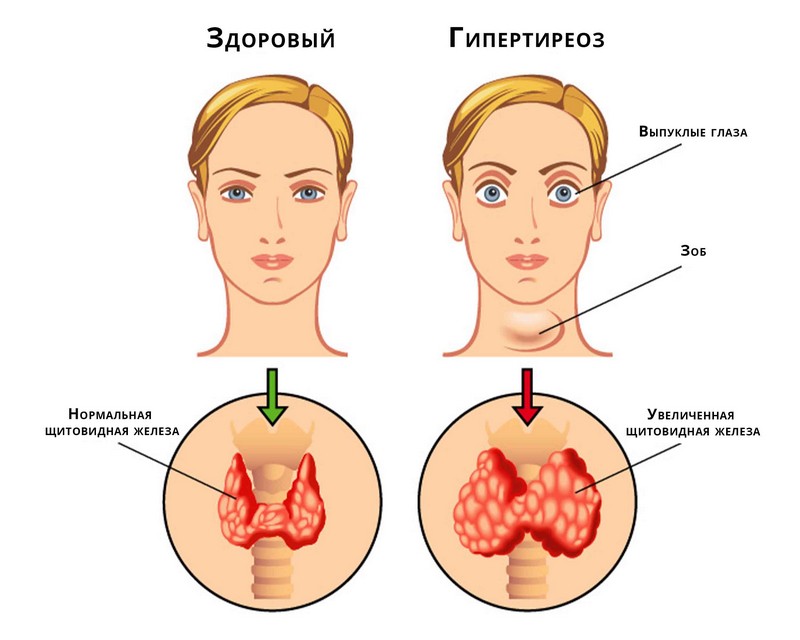Гипертиреоз