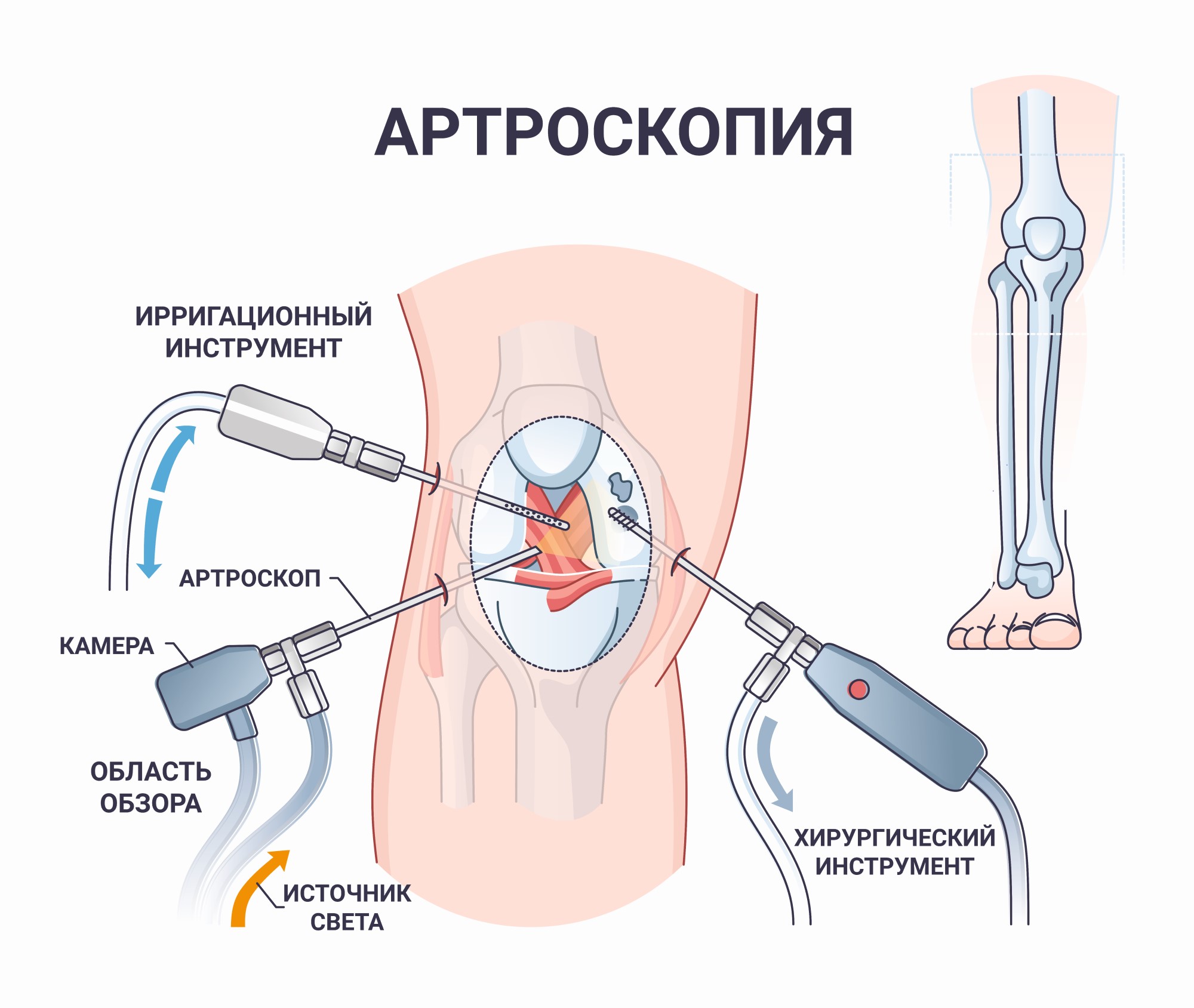 Артроскопия коленного сустава