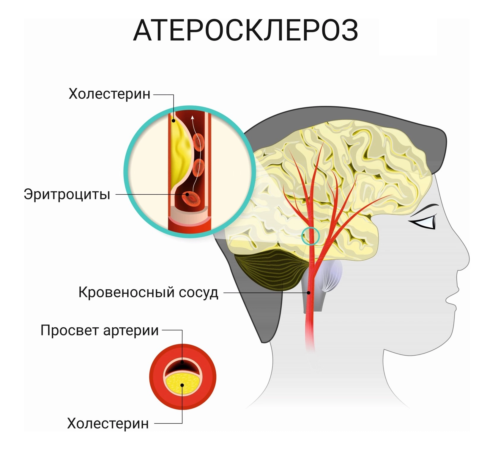 Проблемы с головным мозгом симптомы. Атеросклероз сосудов головного мозга. Атеросклероз церебральных артерий. Атеросклероз сосудов мозга. Атеросклеротическое поражение сосудов головного мозга.