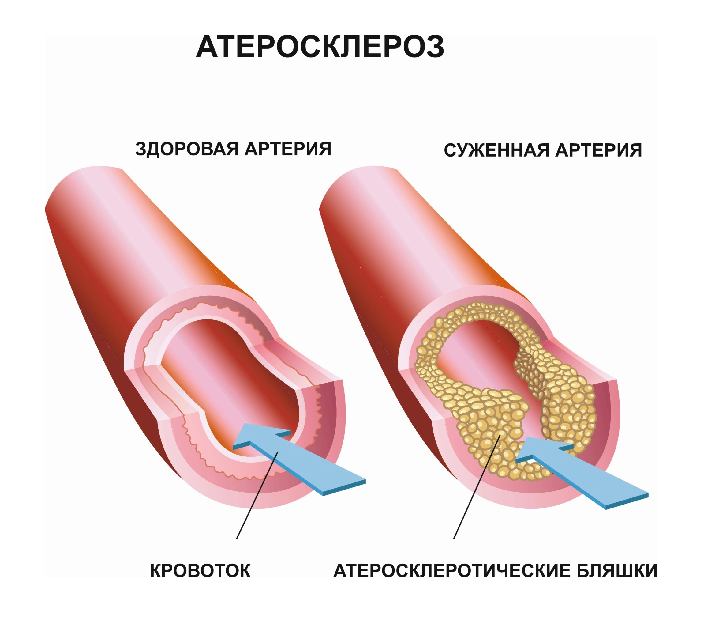 Засор в артерии это