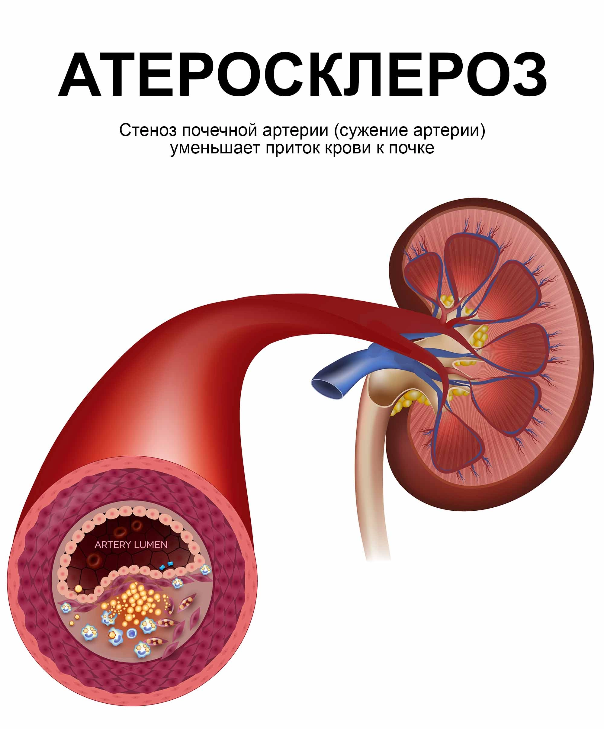 Тромбоз почек. Атеросклероз почечных артерий. Атеросклероз артерий почек. Осложнения атеросклероза артерий почек. Тромбоз почечной артерии.