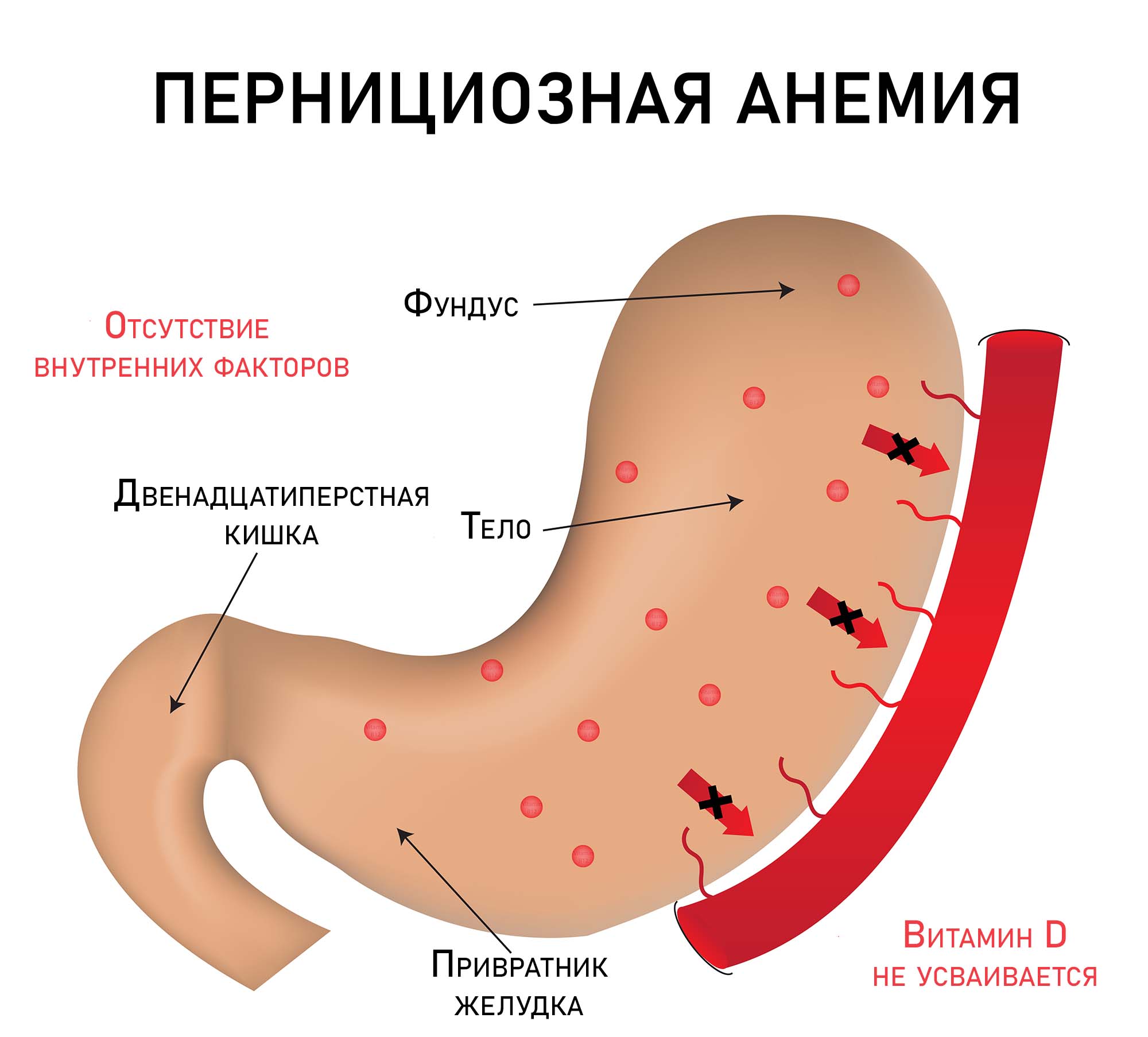 B12-дефицитная анемия
