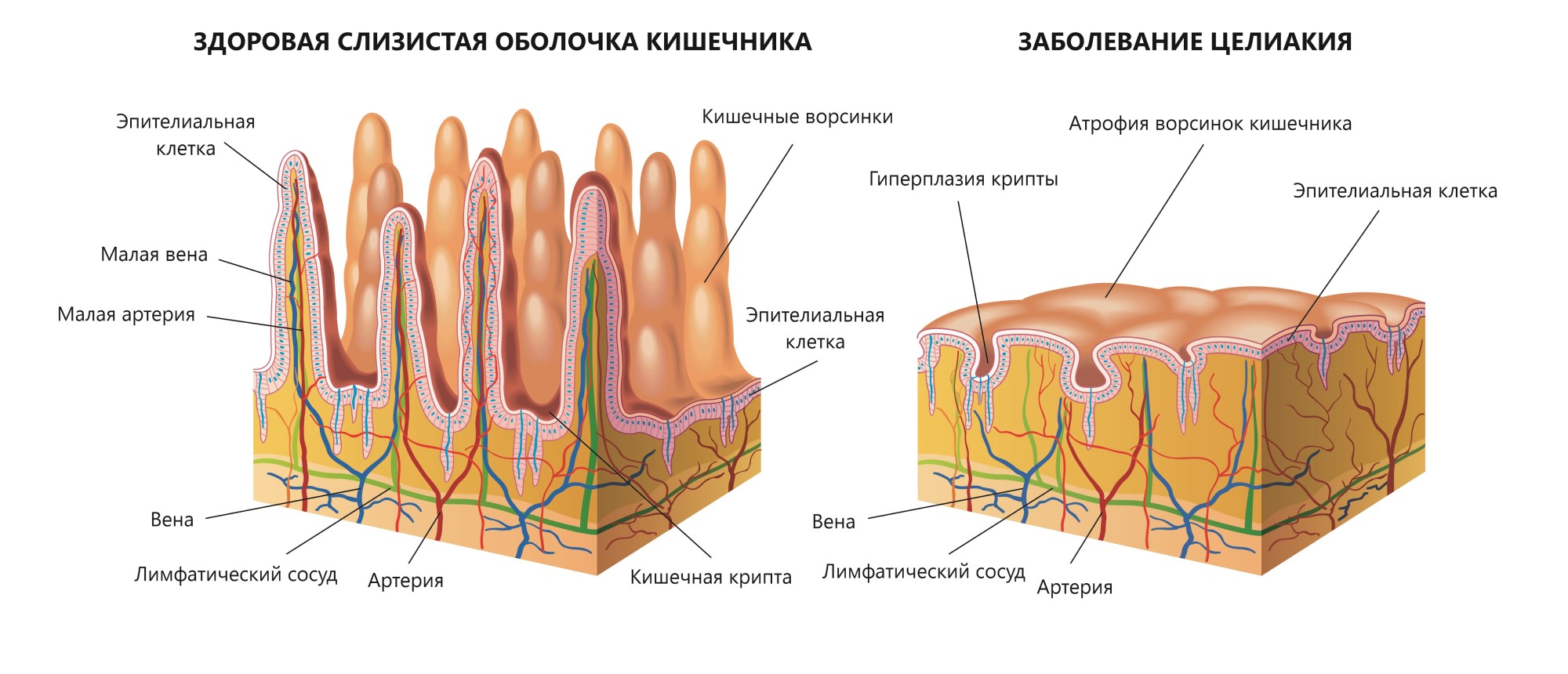 Целиакия - непереносимость глютена