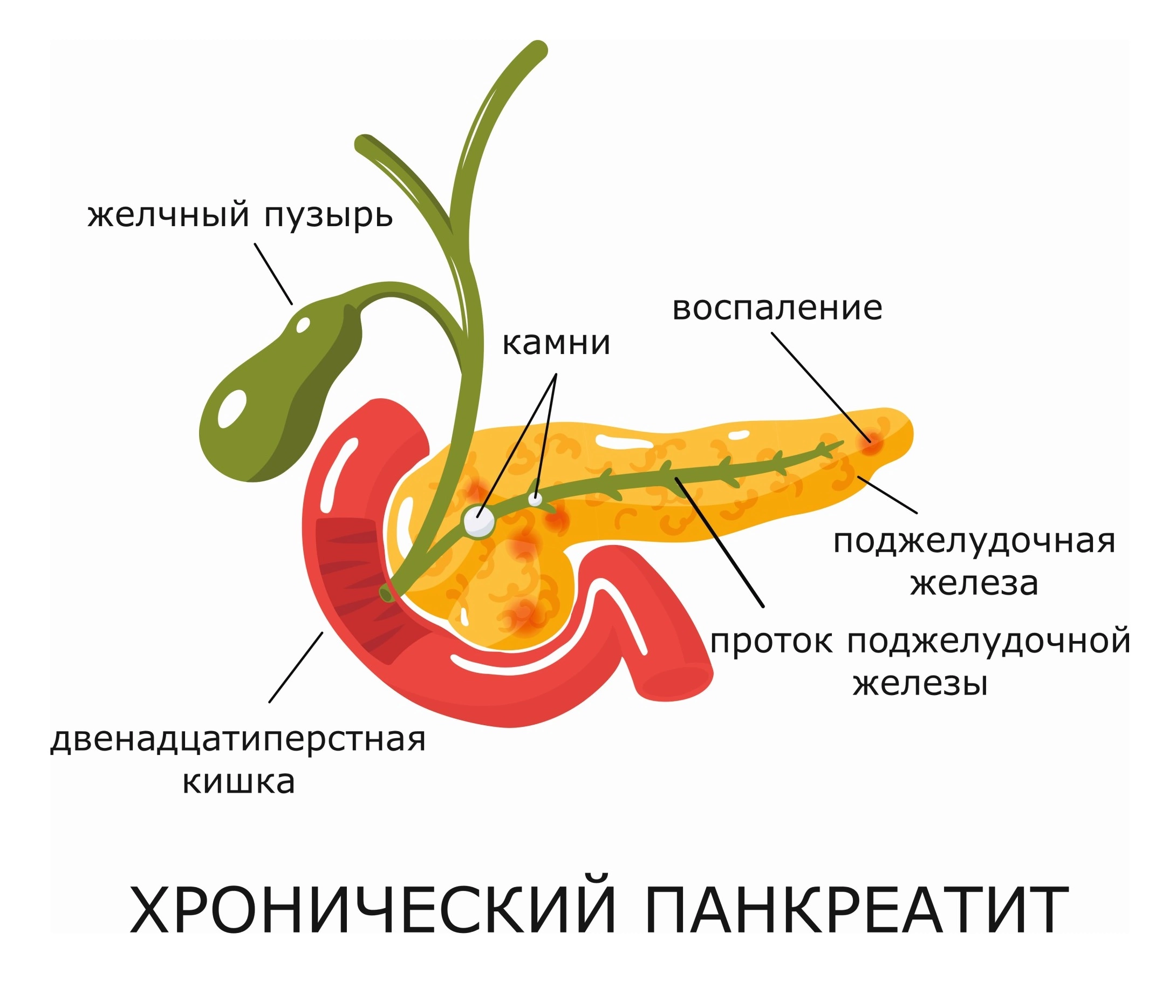 что означает диагноз хронический панкреатит
