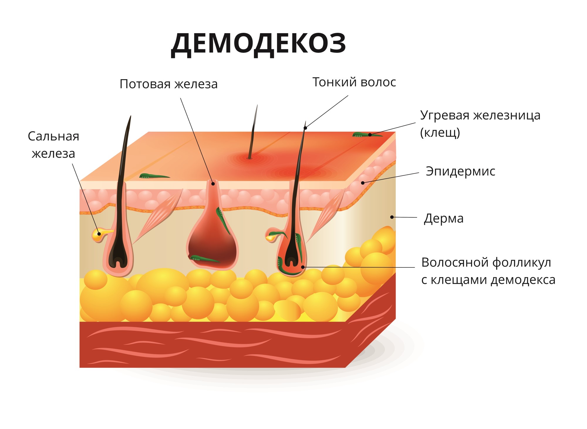 Демодекоз