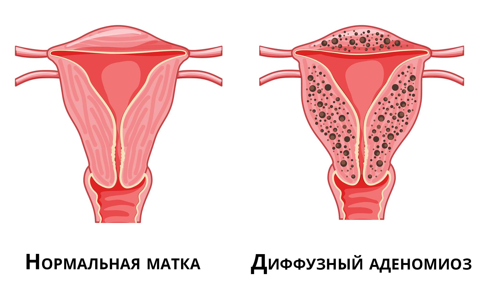 Диффузный аденомиоз матки