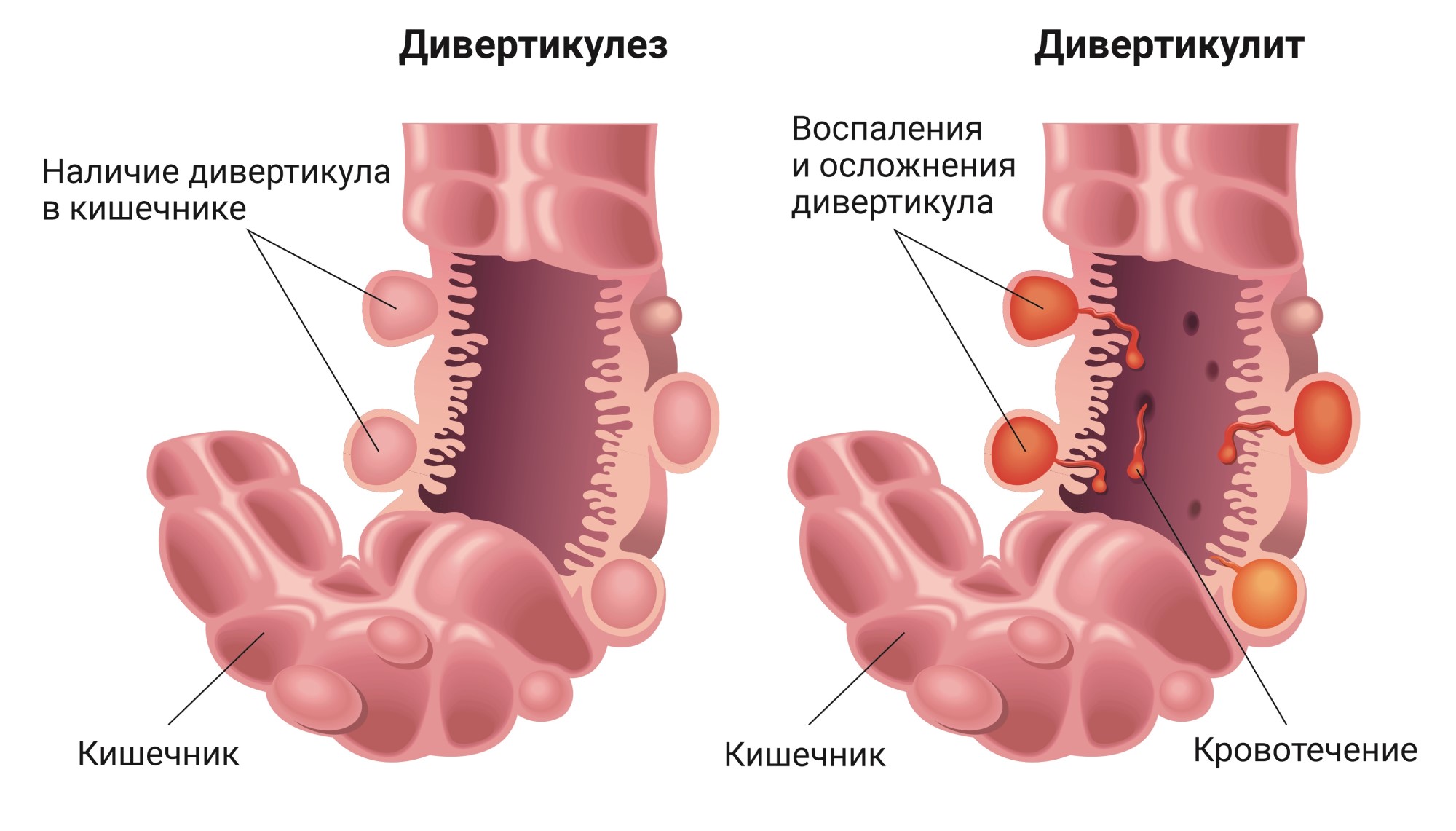 Дивертикулез кишечника