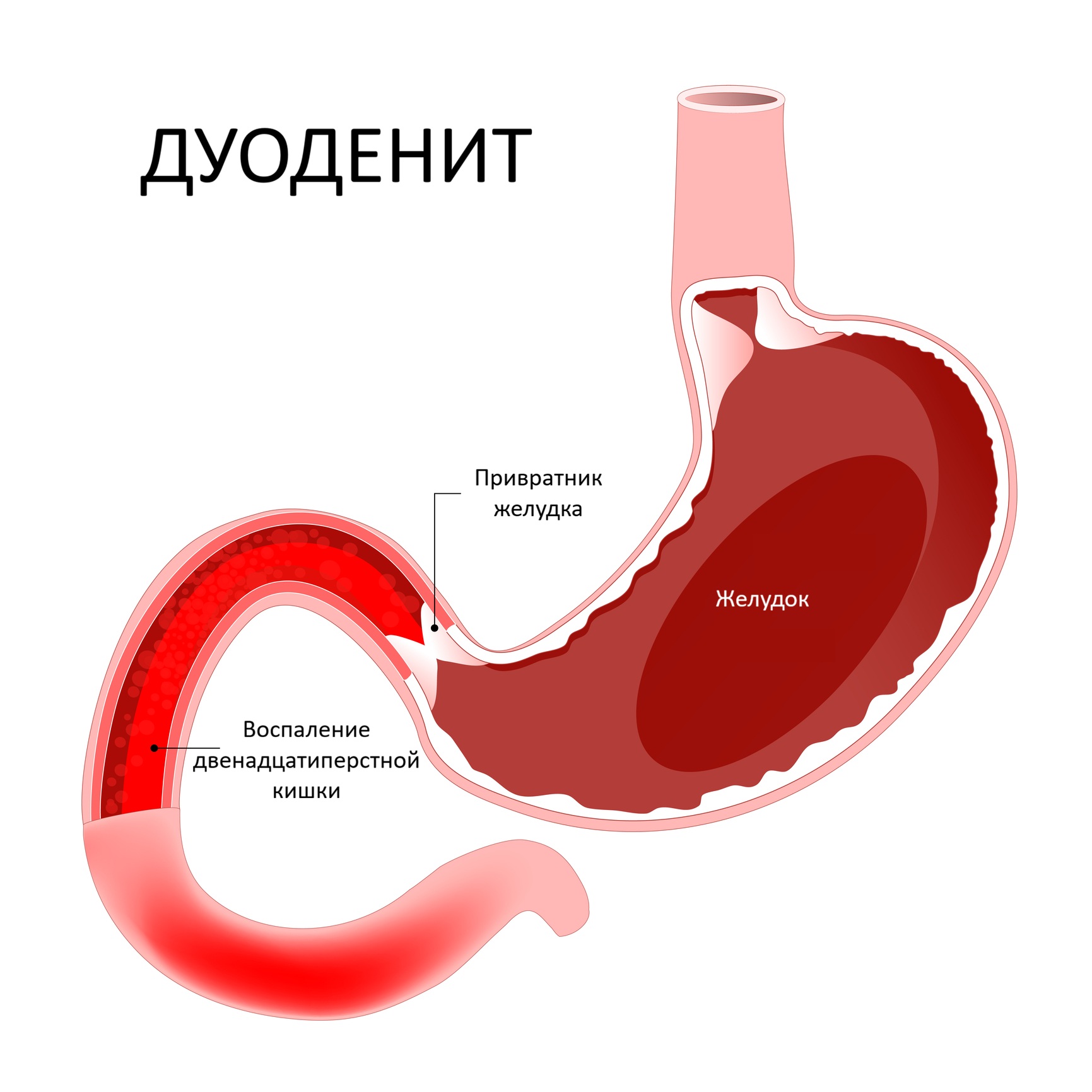 Дуоденит двенадцатиперстной кишки
