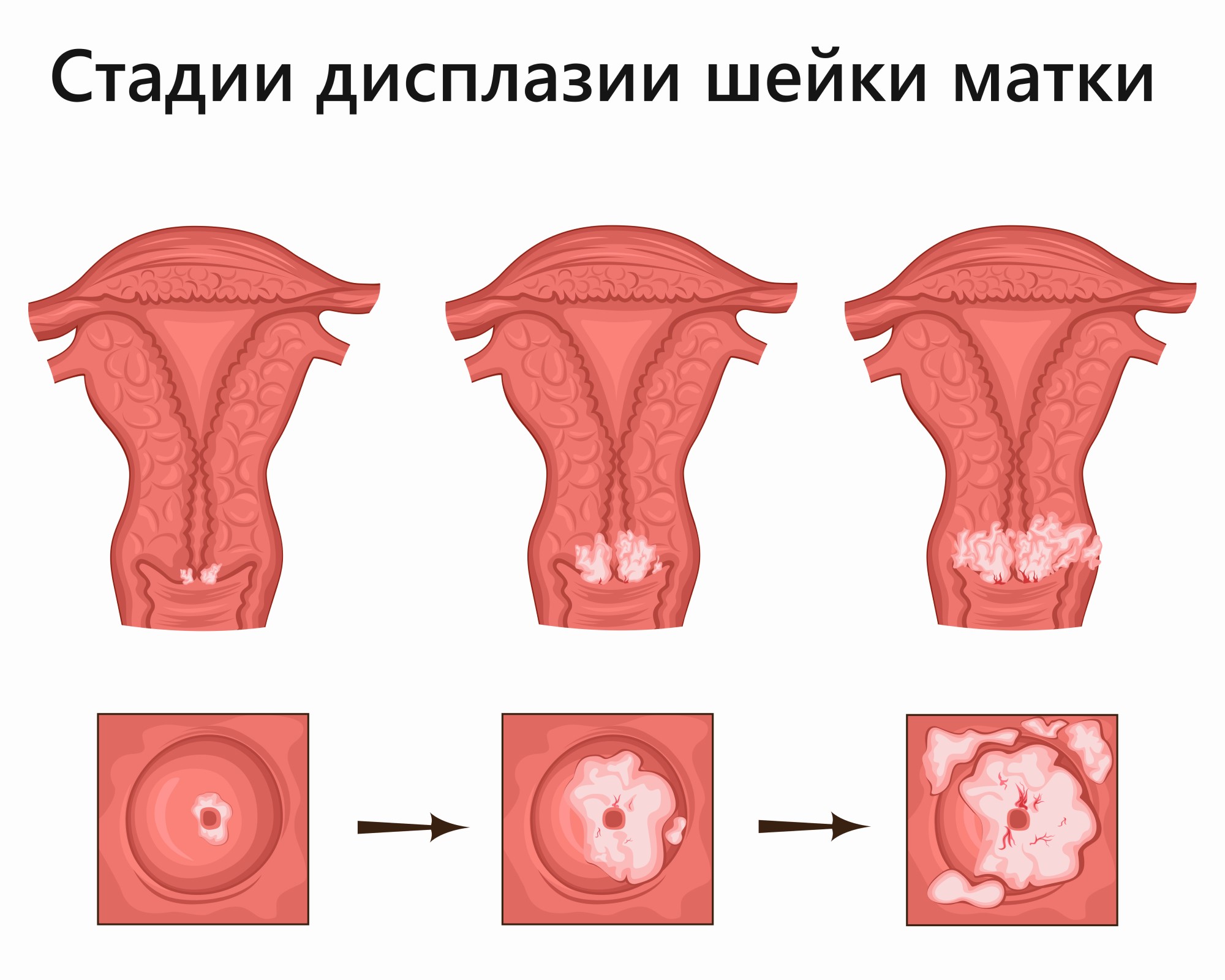 Дисплазия