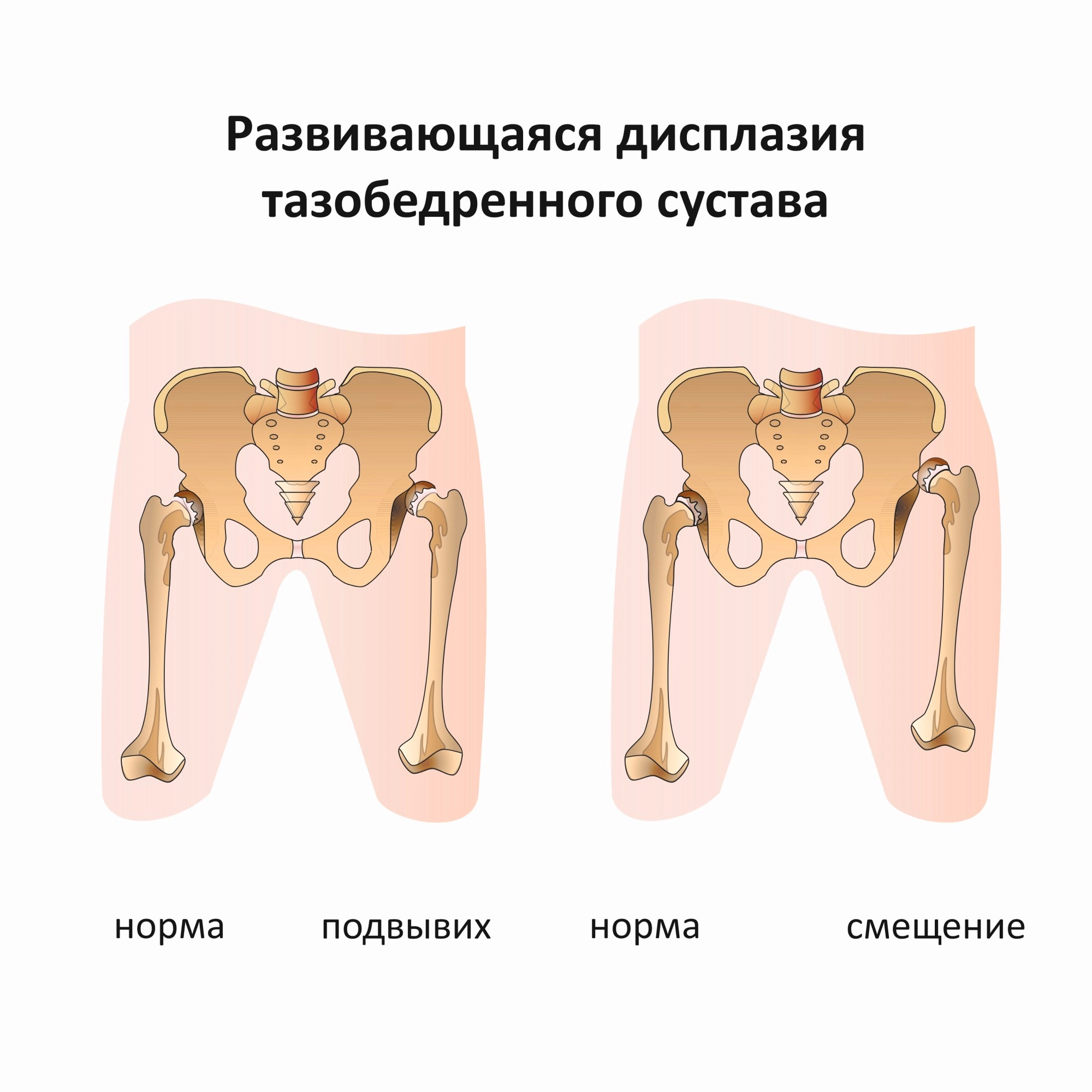 Дисплазия тазобедренного сустава – клиника «Семейный доктор».