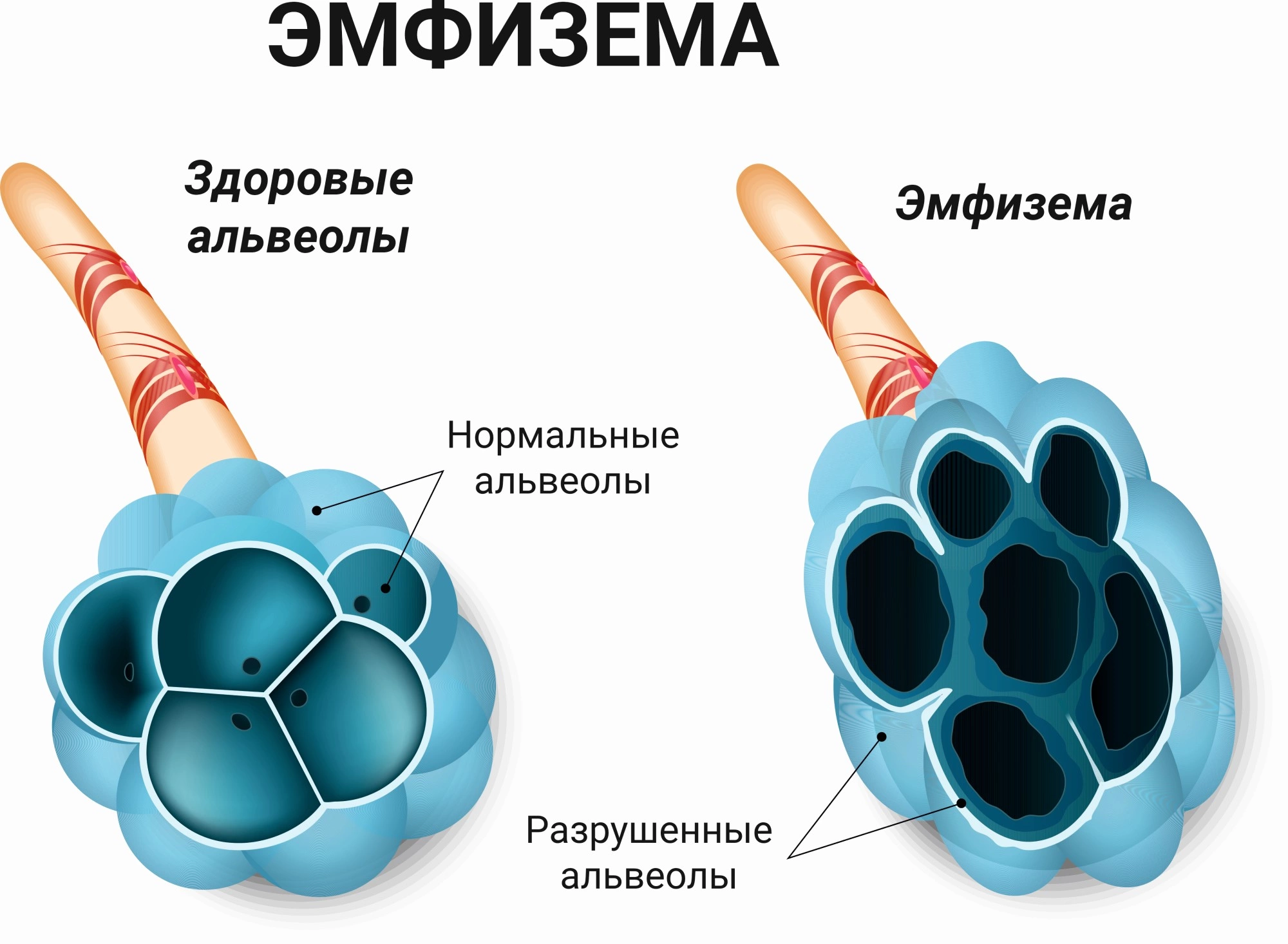 Эмфизема легких