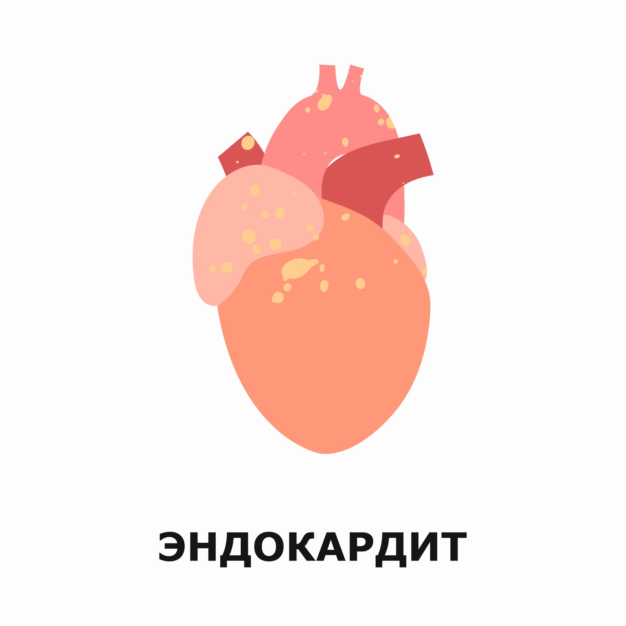 Эндокардит