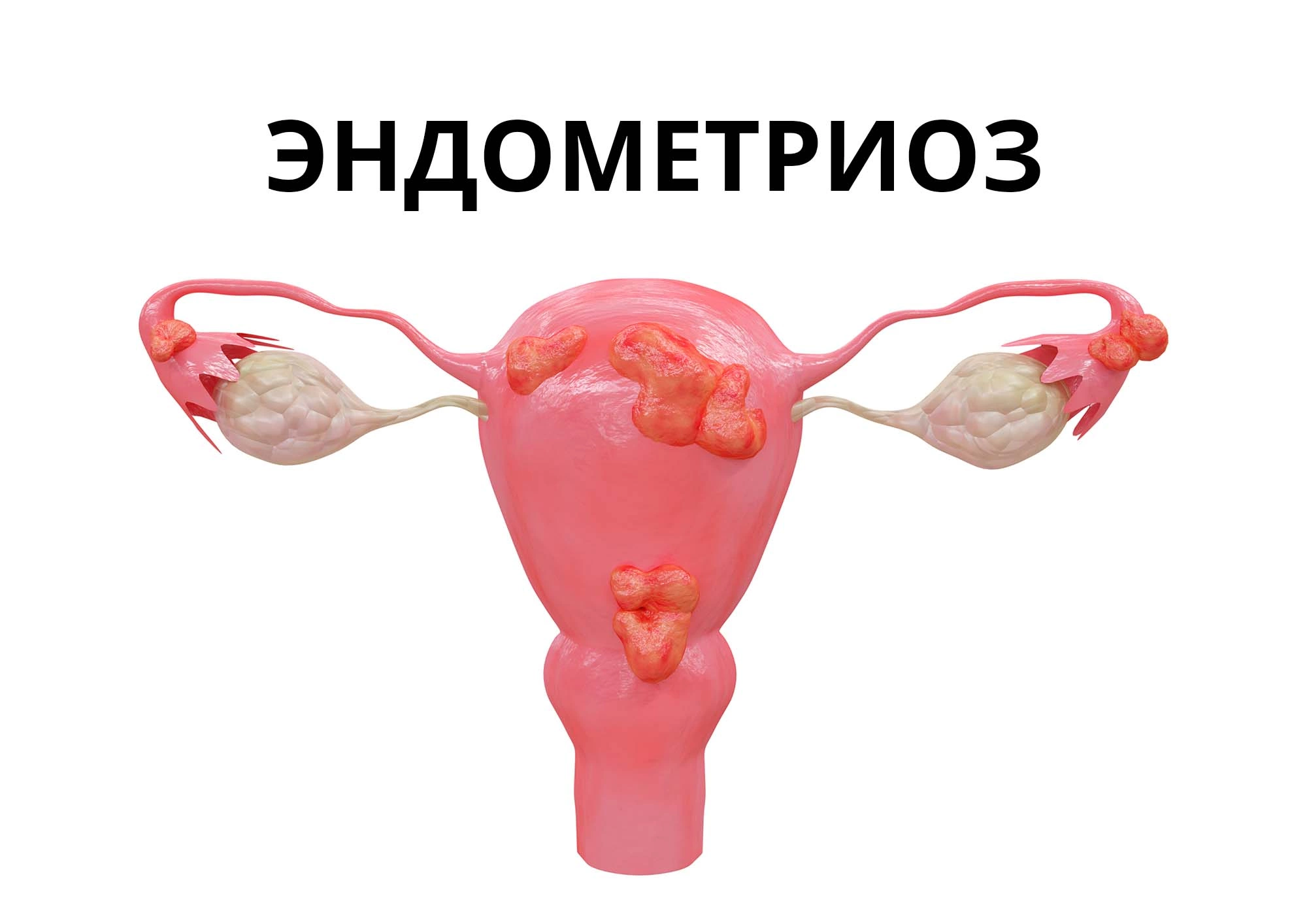 Эндометриоз и беременность - можно ли забеременеть?