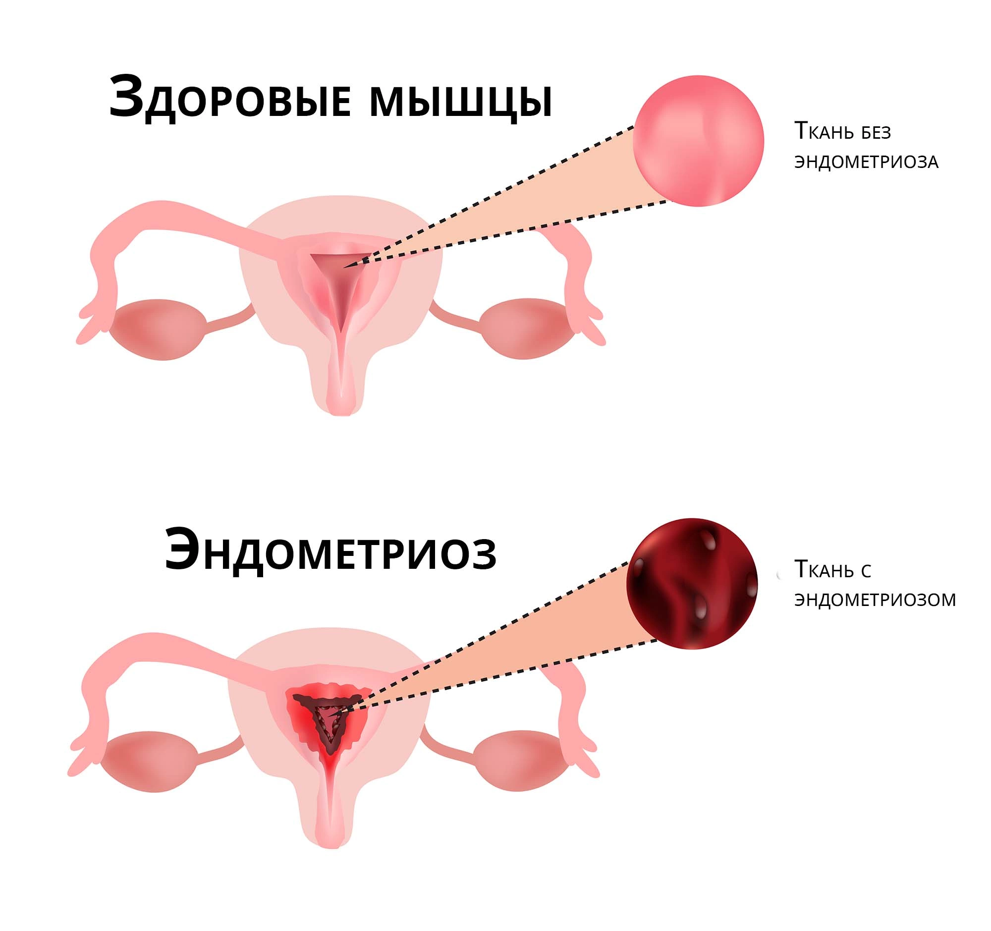 Эндометриоз при климаксе (в менопаузе): симптомы, лечение, проходит ли
