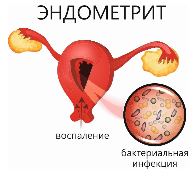 Эндометрит