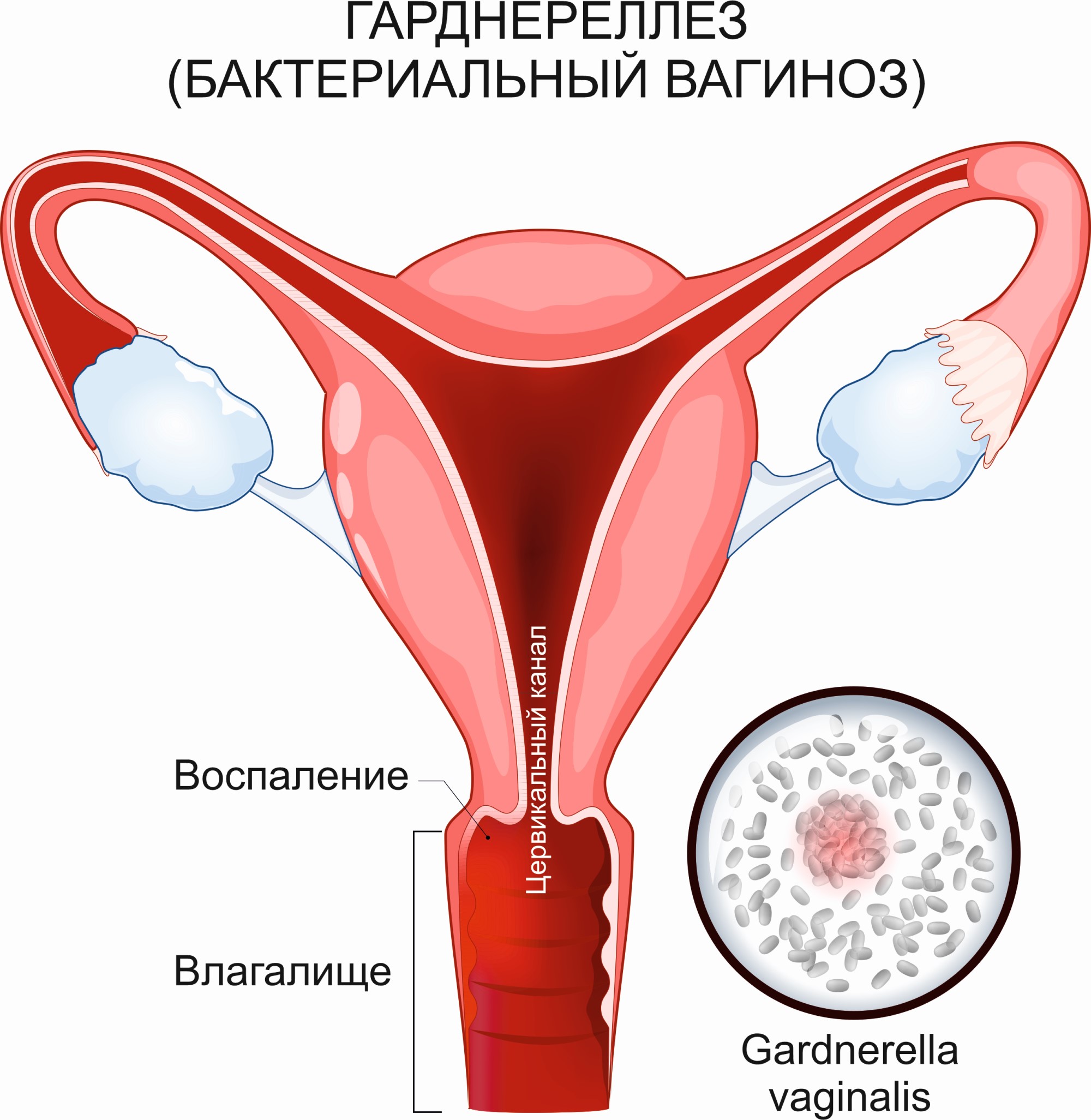 Гарднереллез