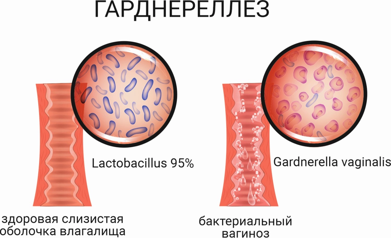 Гарднерелла у женщин и мужчин, лечение гарднереллеза, откуда он берется, симптомы