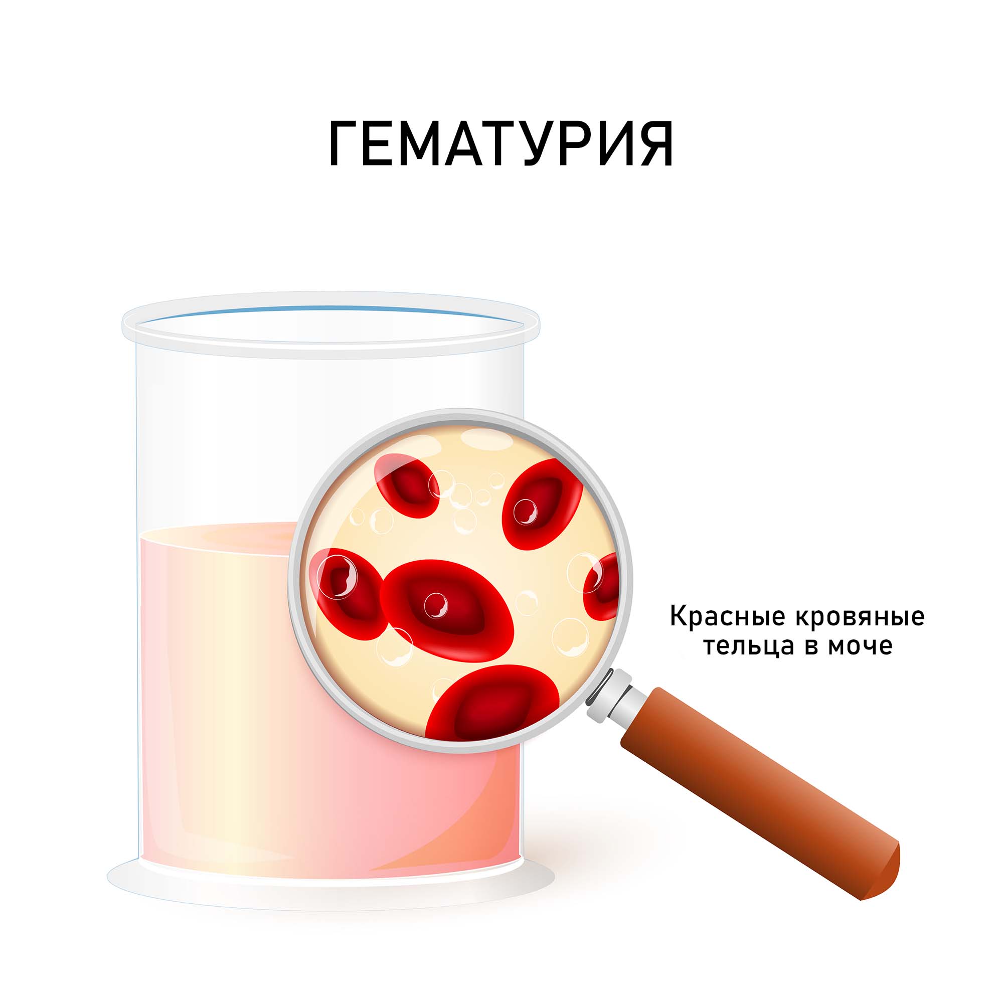 Кровь в моче (гематурия)