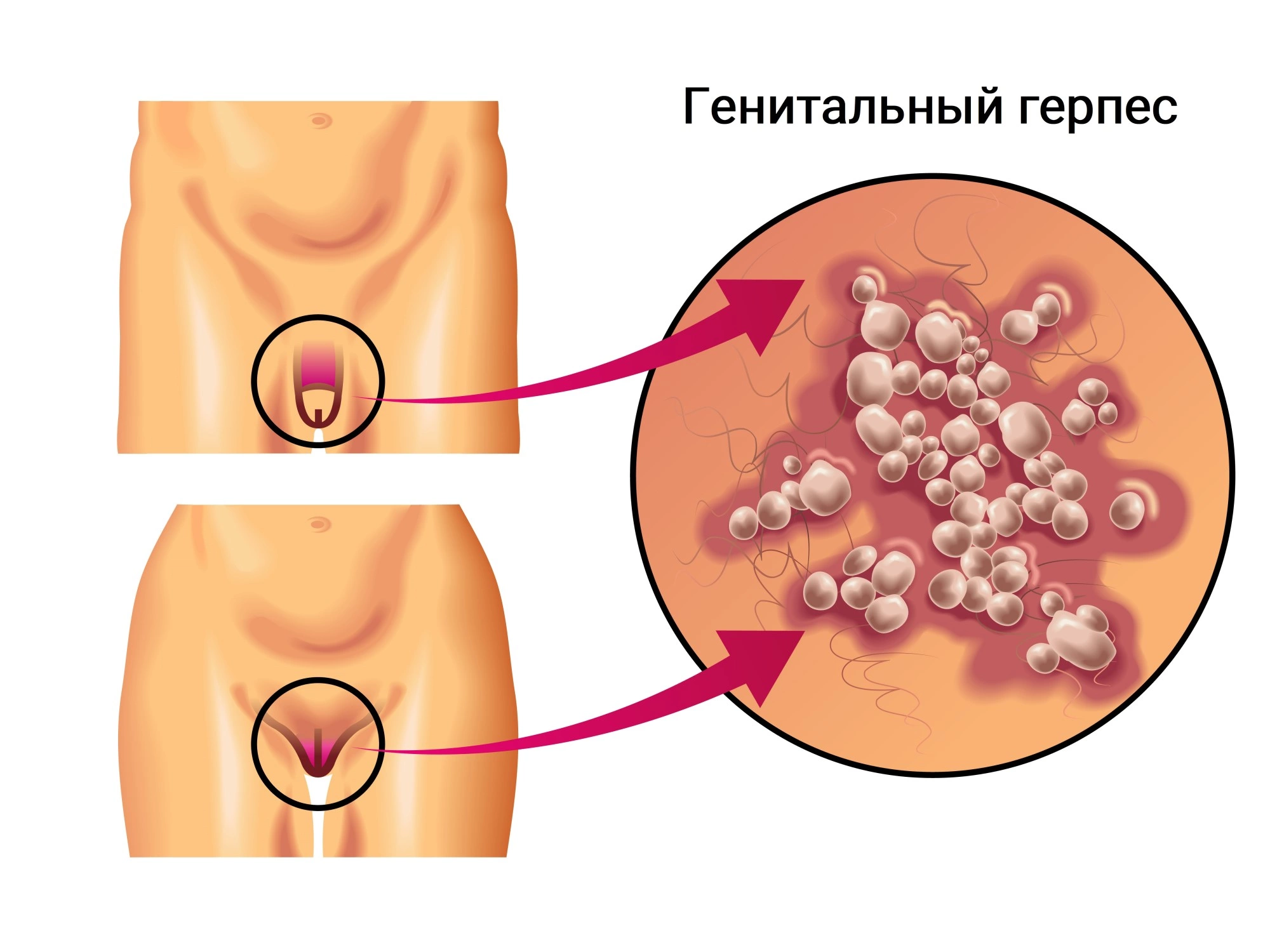 Лечение генитального герпеса у женщин