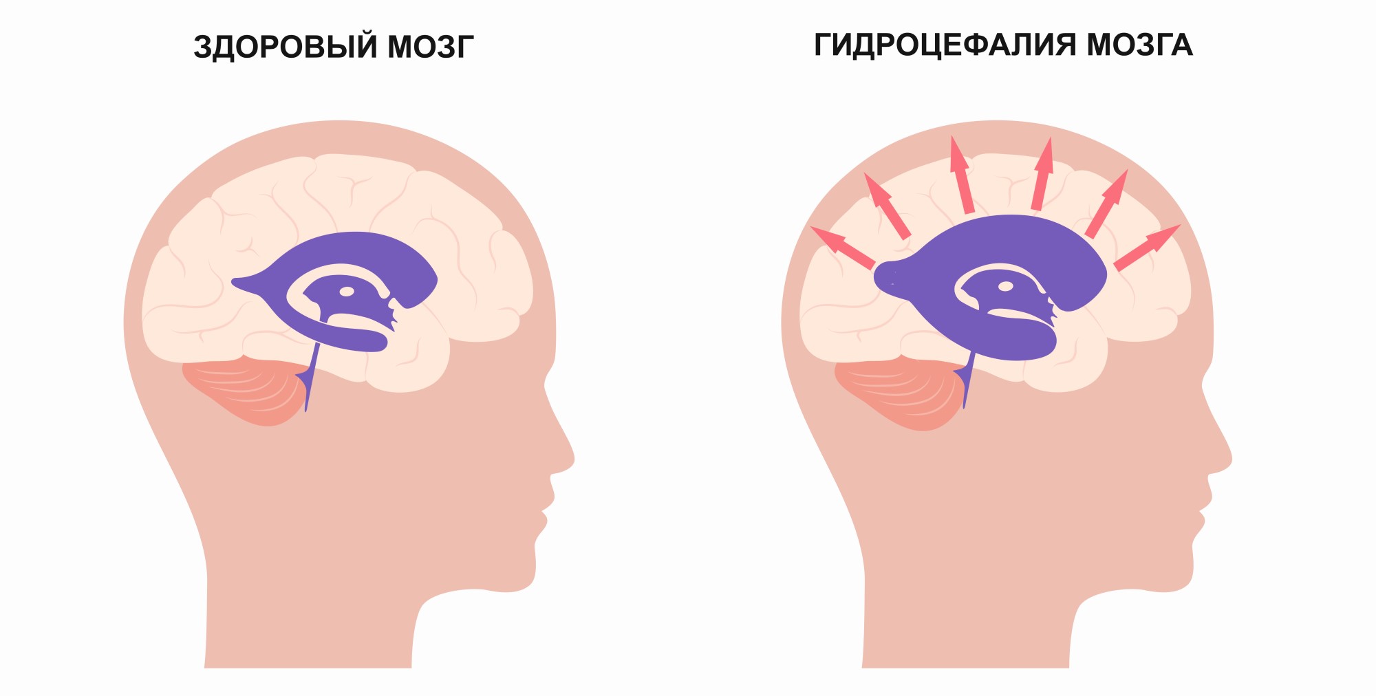 Гидроцефалия