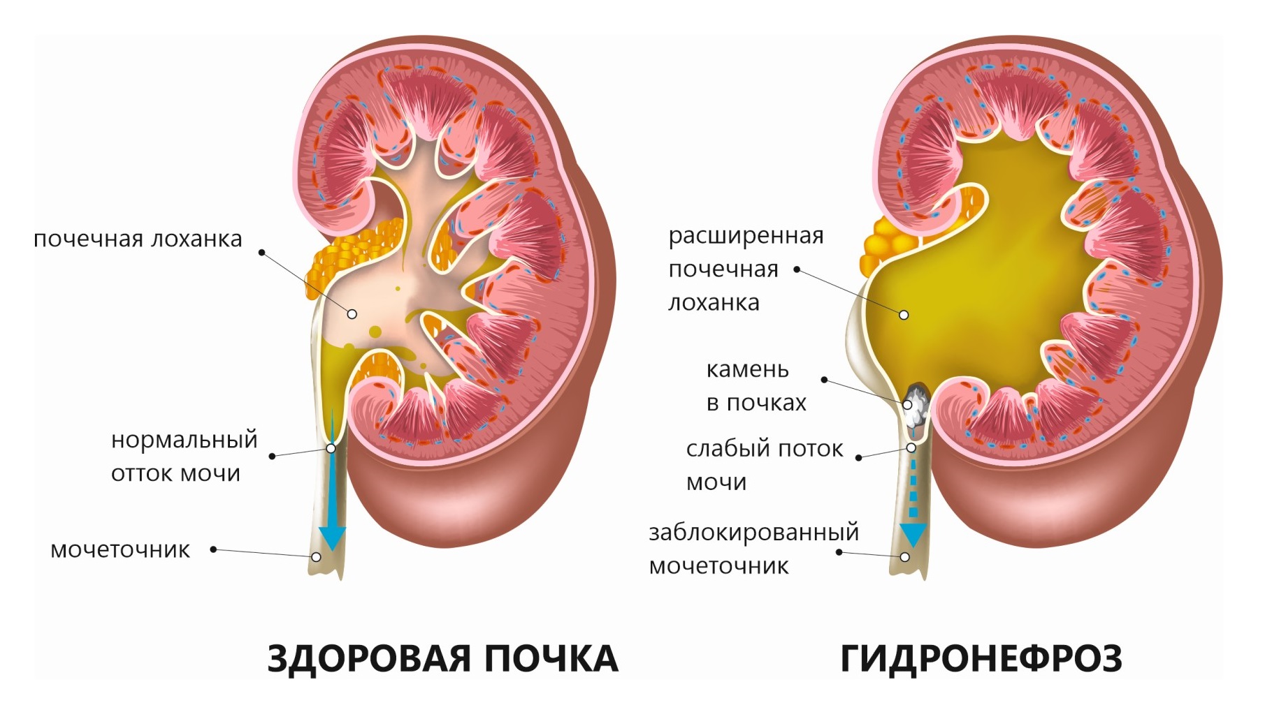 Гидронефроз почек