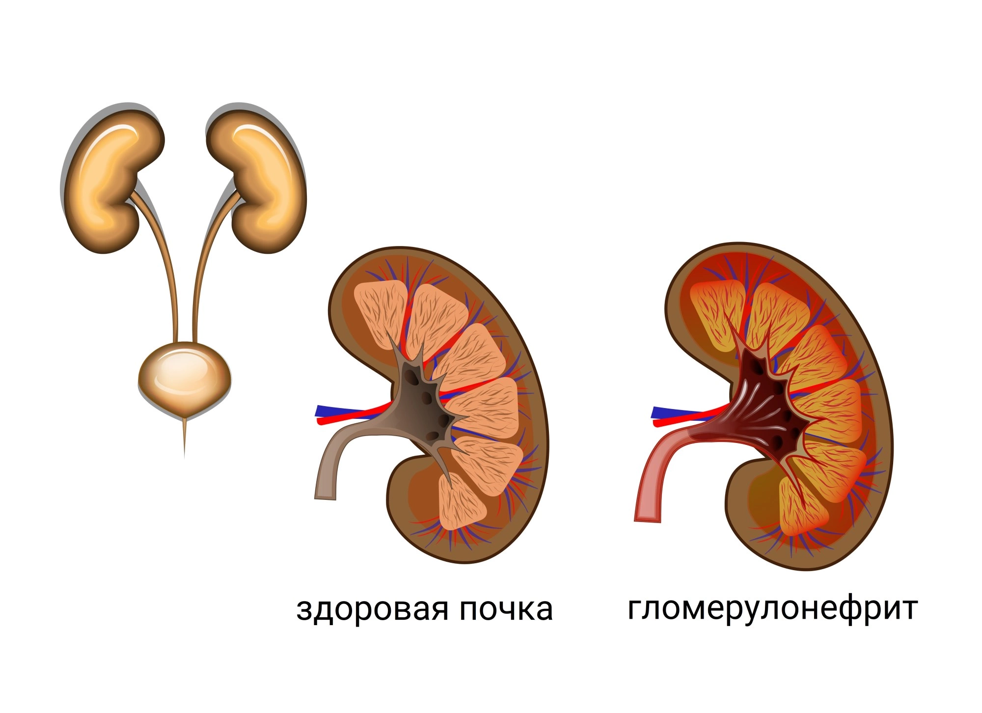 Здоровая почка и гломерулонефрит. Острый гломерулонефрит у детей симптомы.