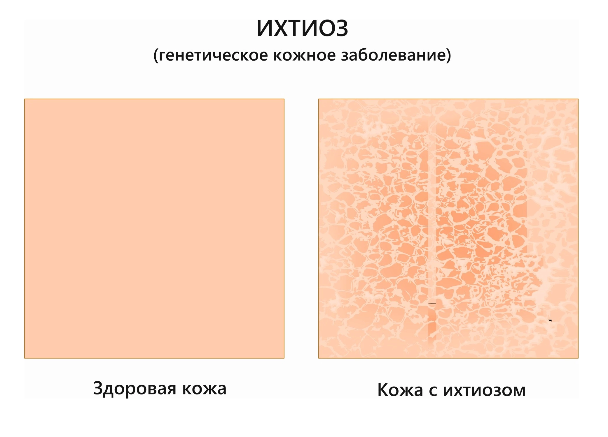 Ихтиоз: что это за болезнь кожи, лечение симптомы, причины, виды