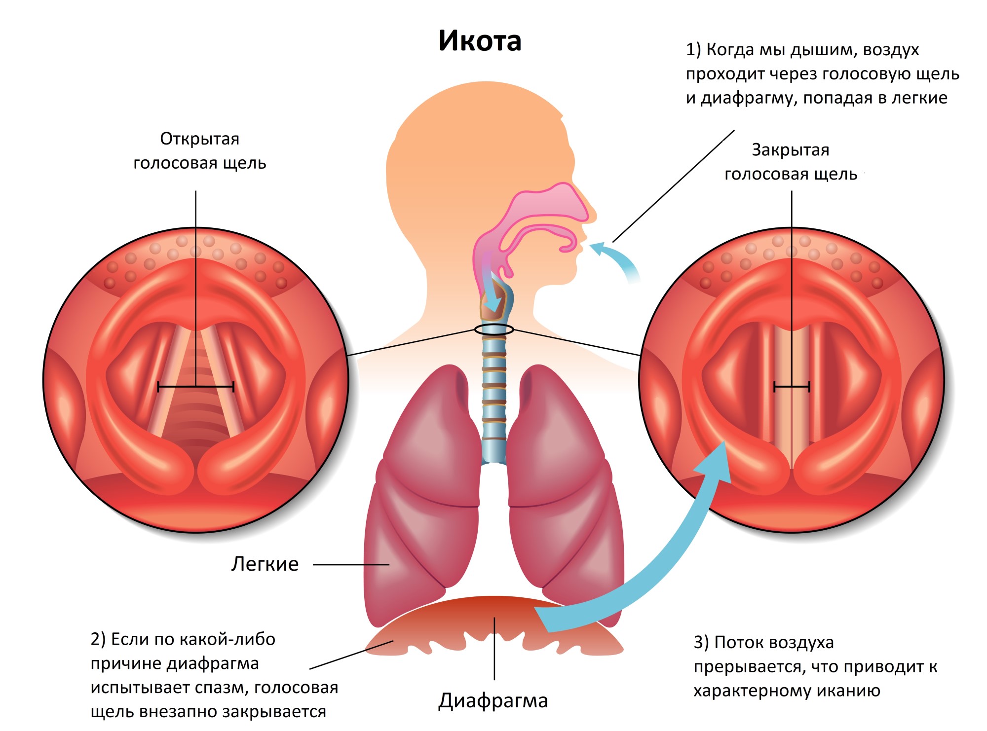 Как остановить икоту