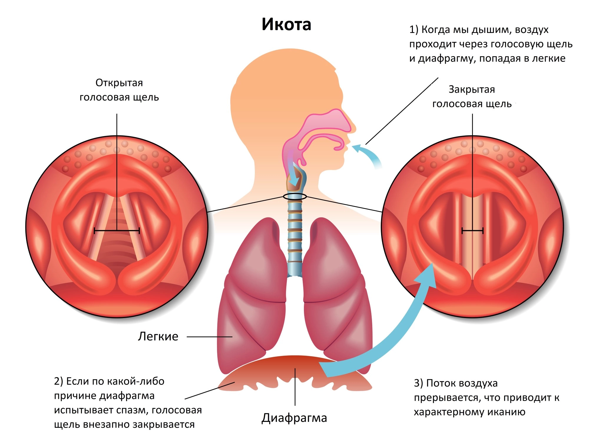 Как остановить икоту самостоятельно?