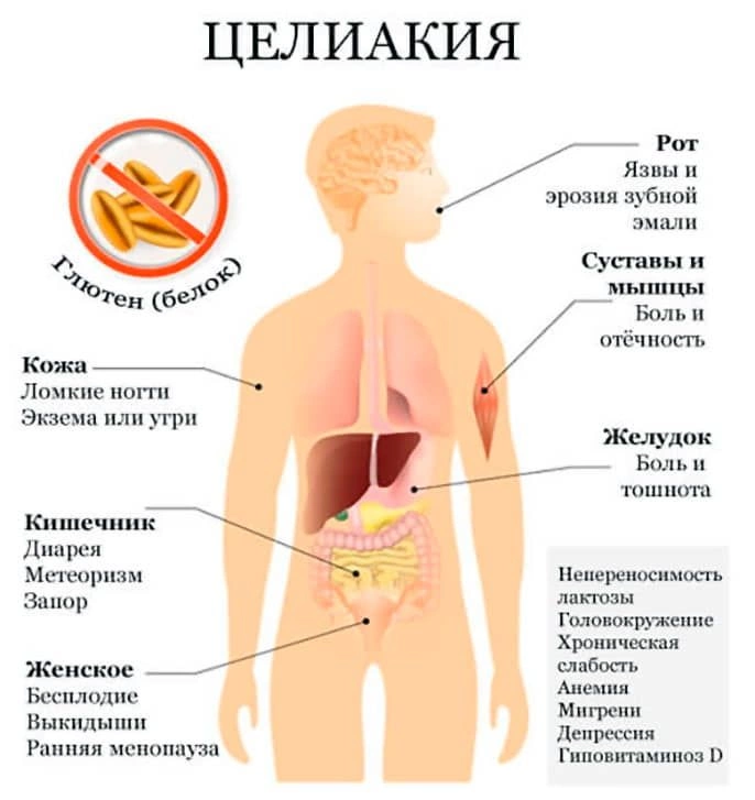 Целиакия - непереносимость глютена