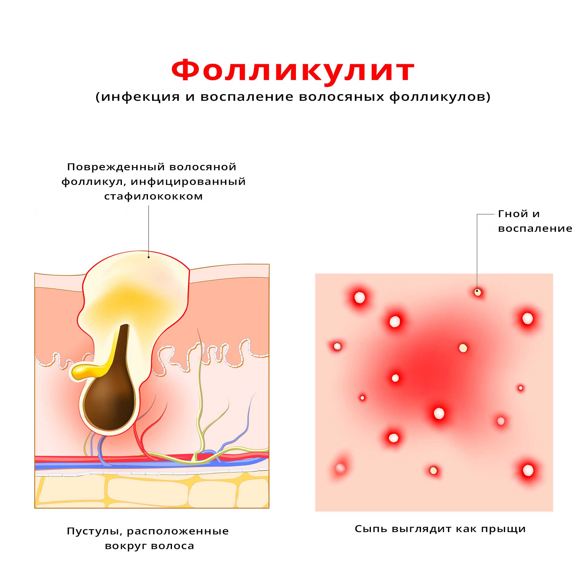 Фолликулит