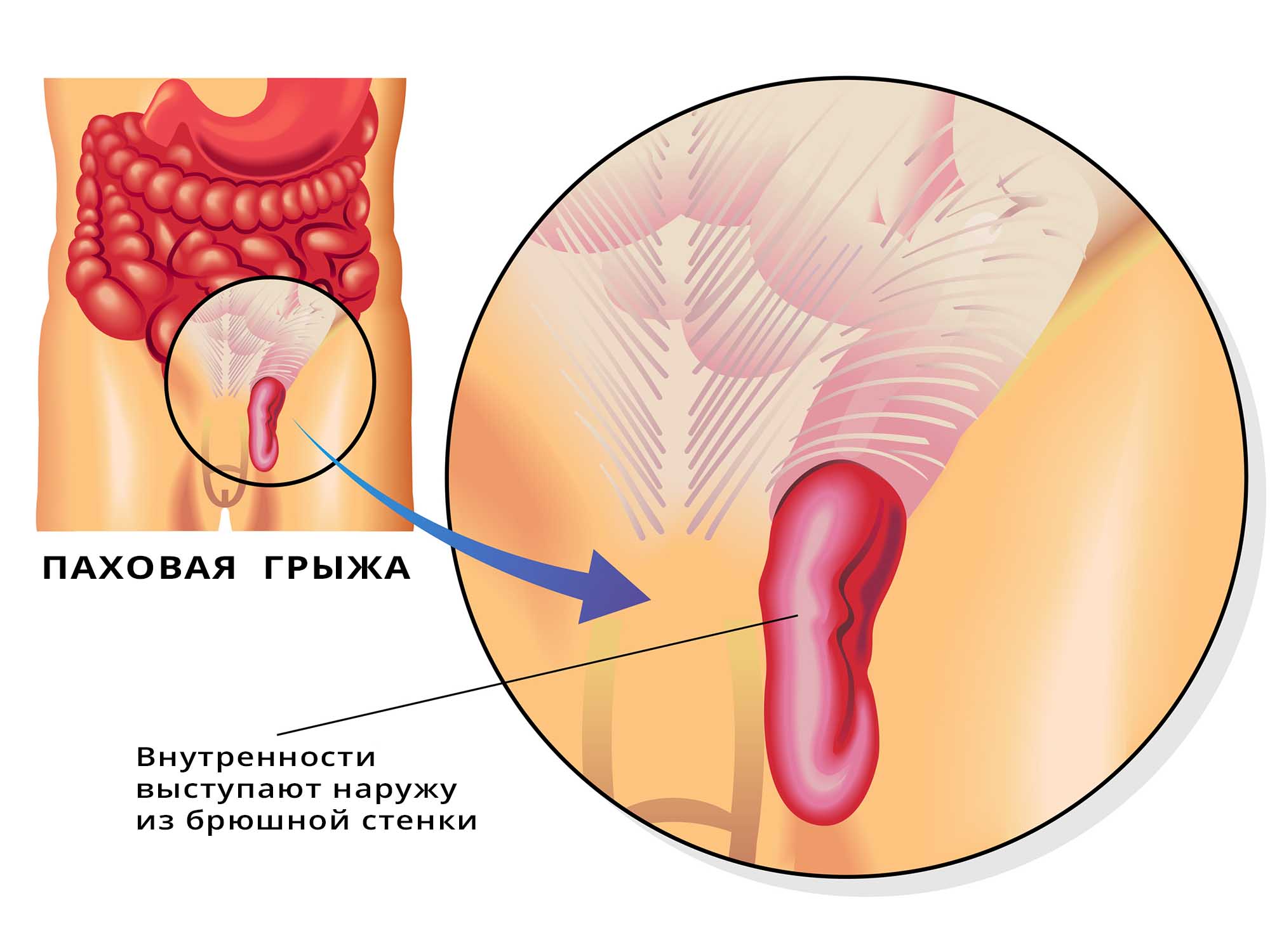 Паховая грыжа