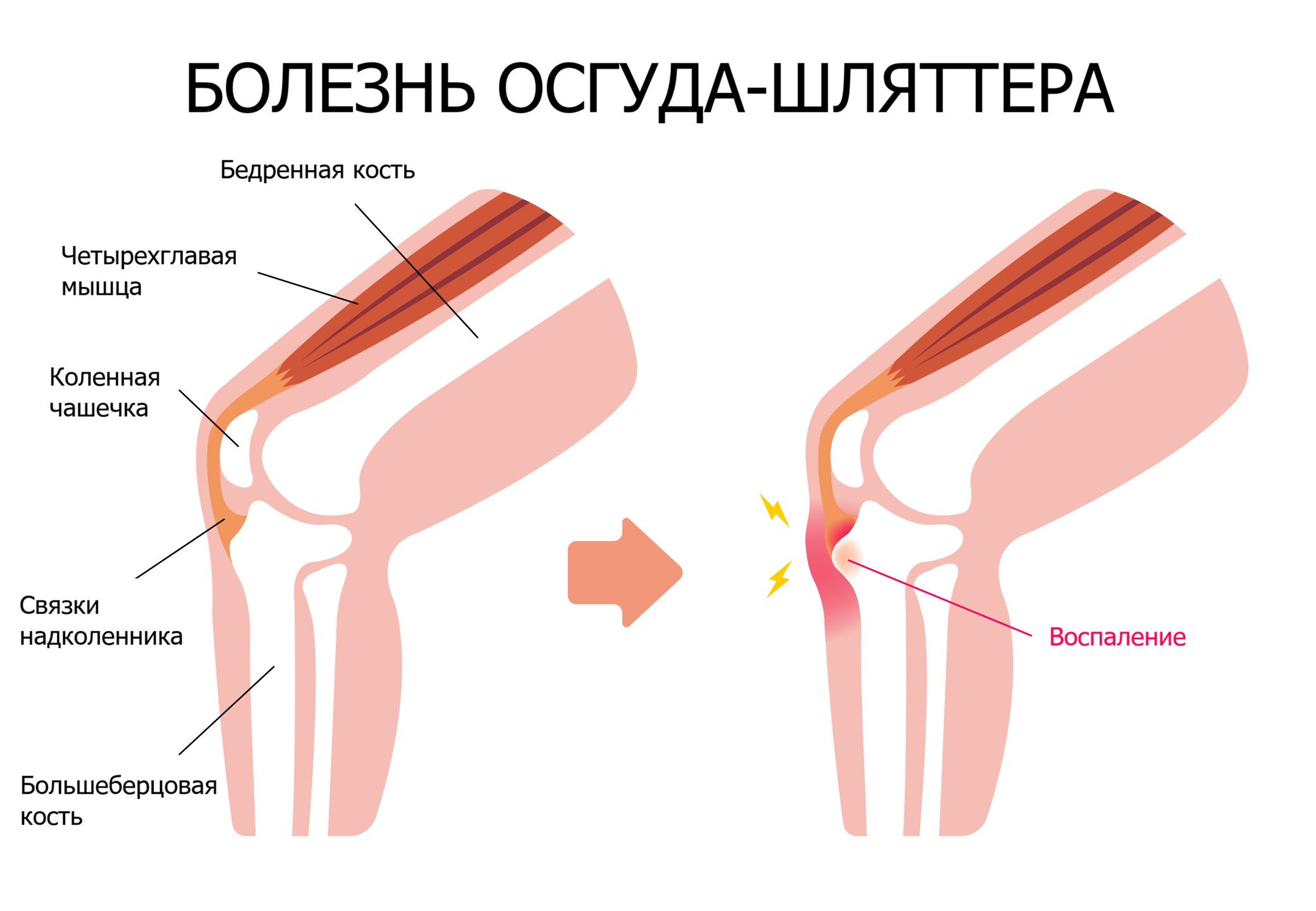 Болезнь Осгуда-Шляттера