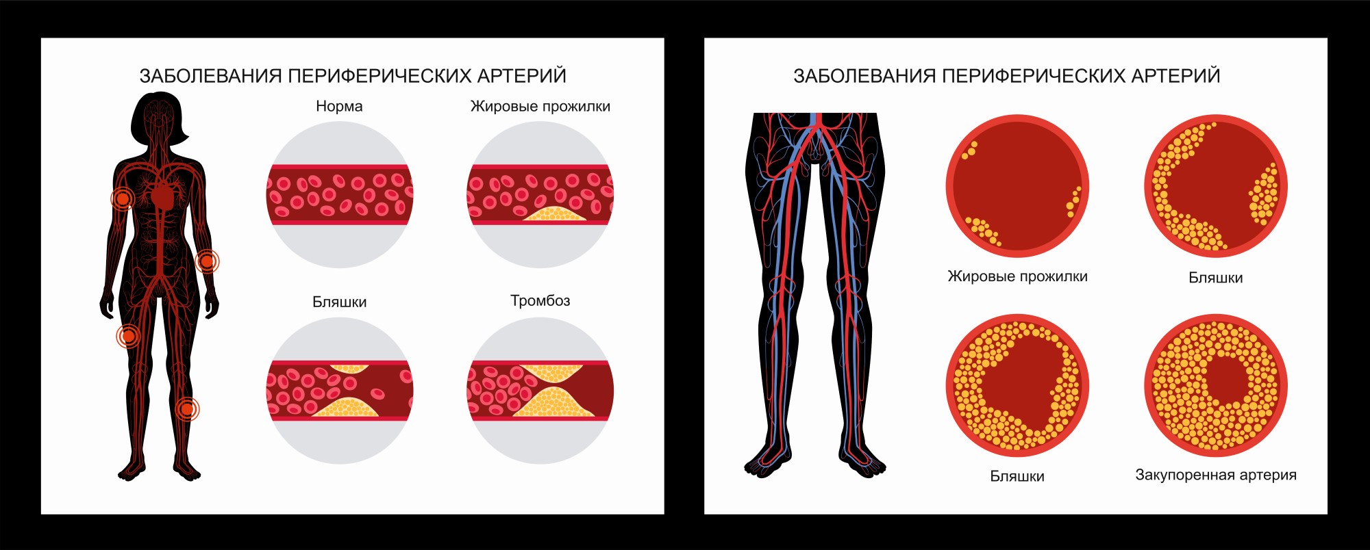 Ишемия нижних конечностей