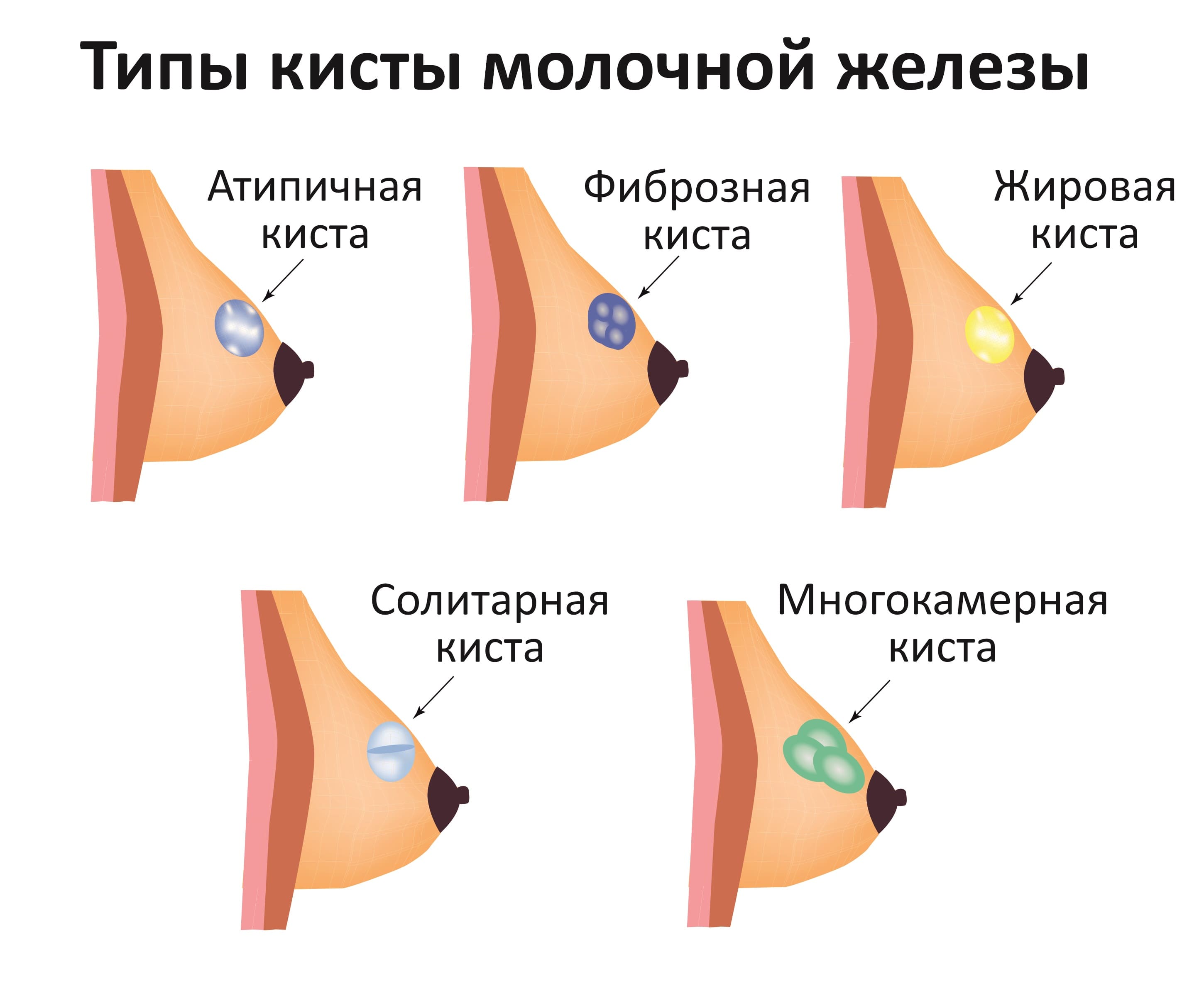 чем лечить кисту женской груди (119) фото