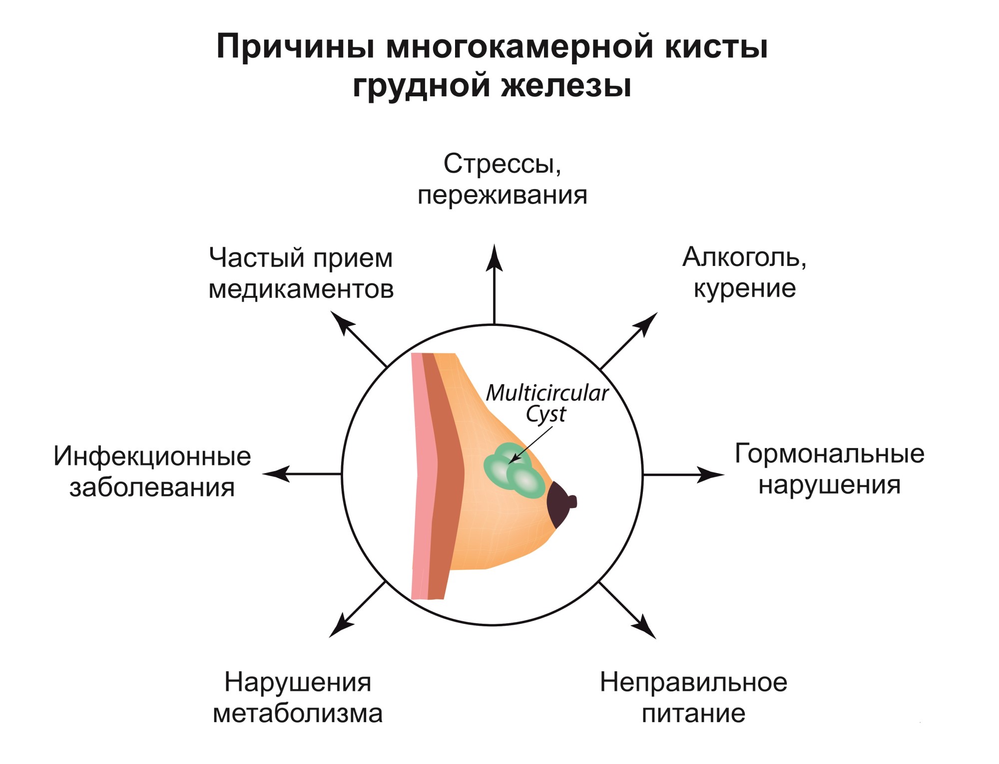 Киста молочной железы