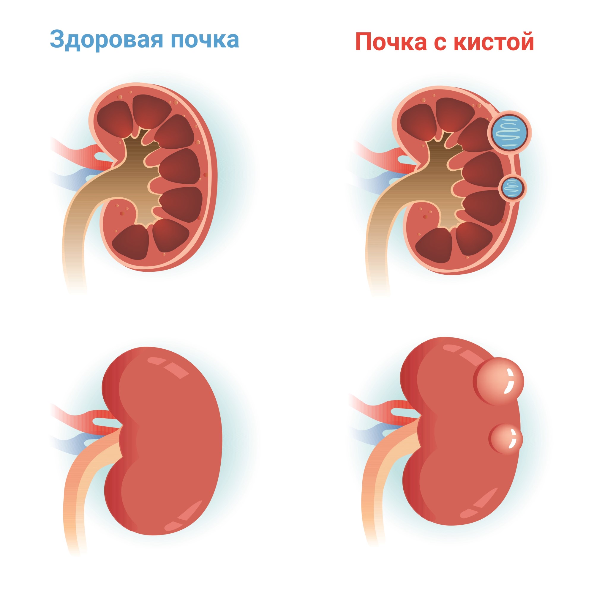 Сколько кист в почках