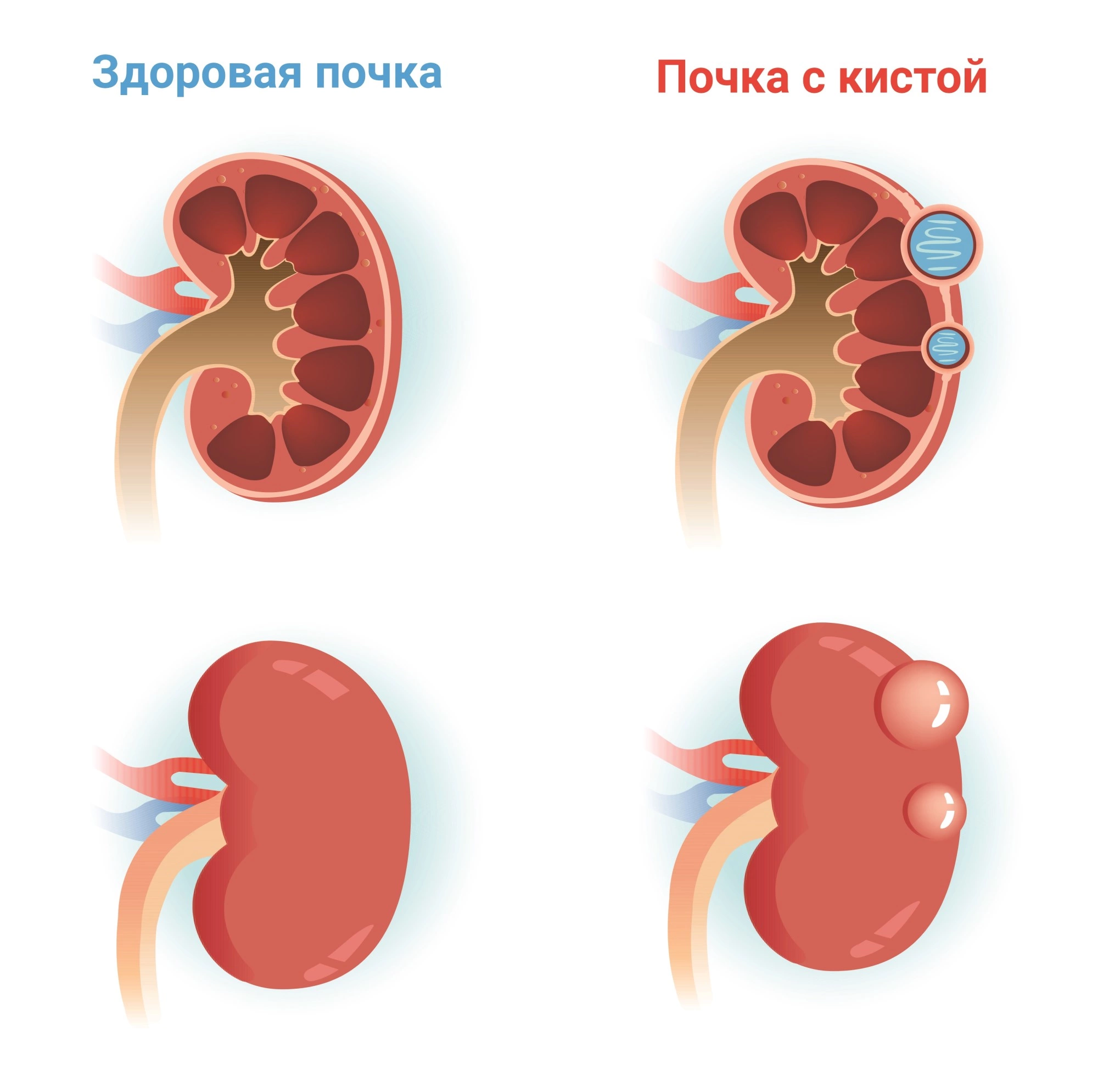 kista pochki simptomy