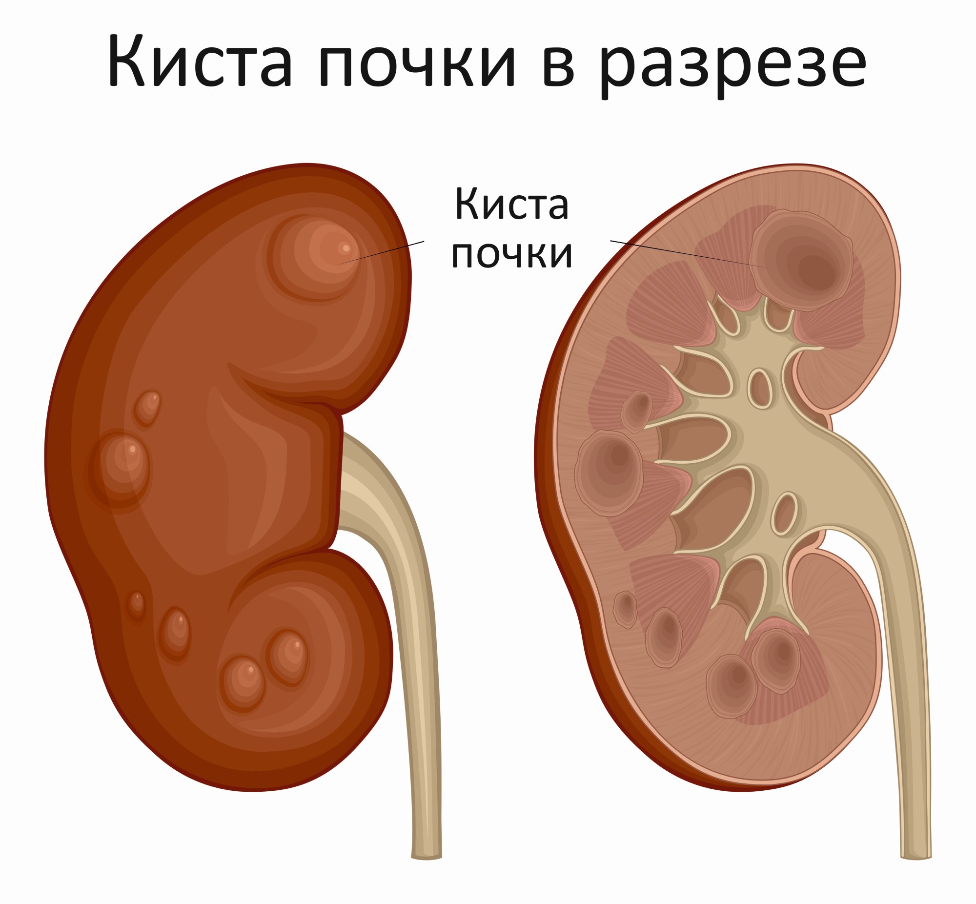 Кисты почек презентация