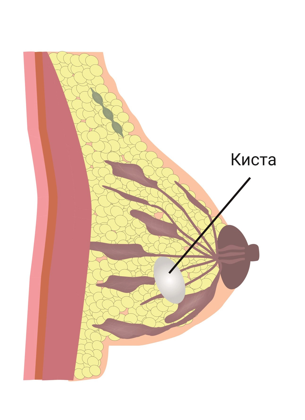 Киста молочной (грудной) железы - лечение кисты в груди у женщин
