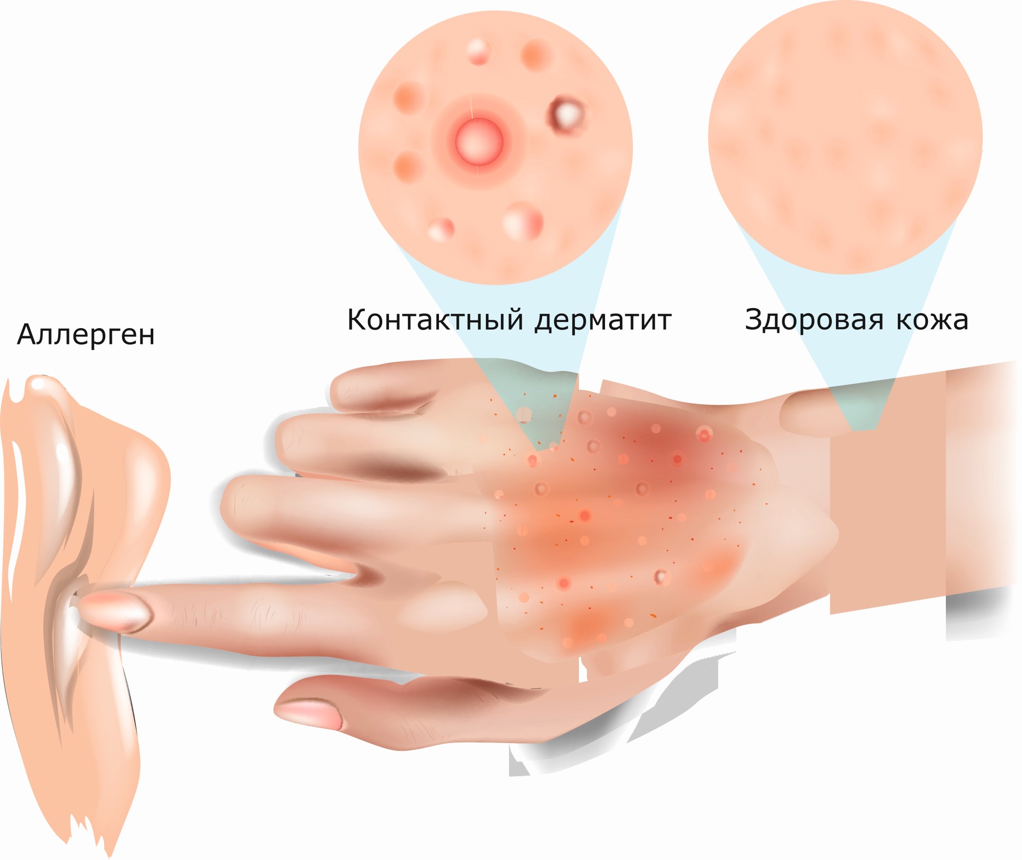 Контактный аллергический дерматит