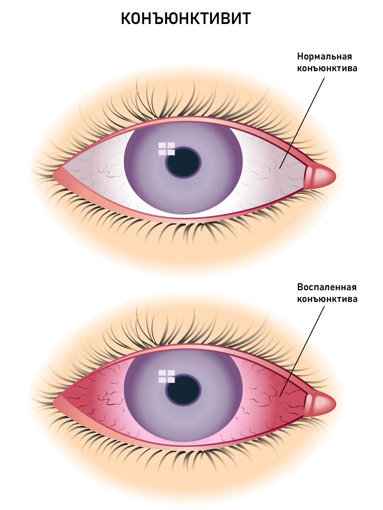 Конъюнктивит