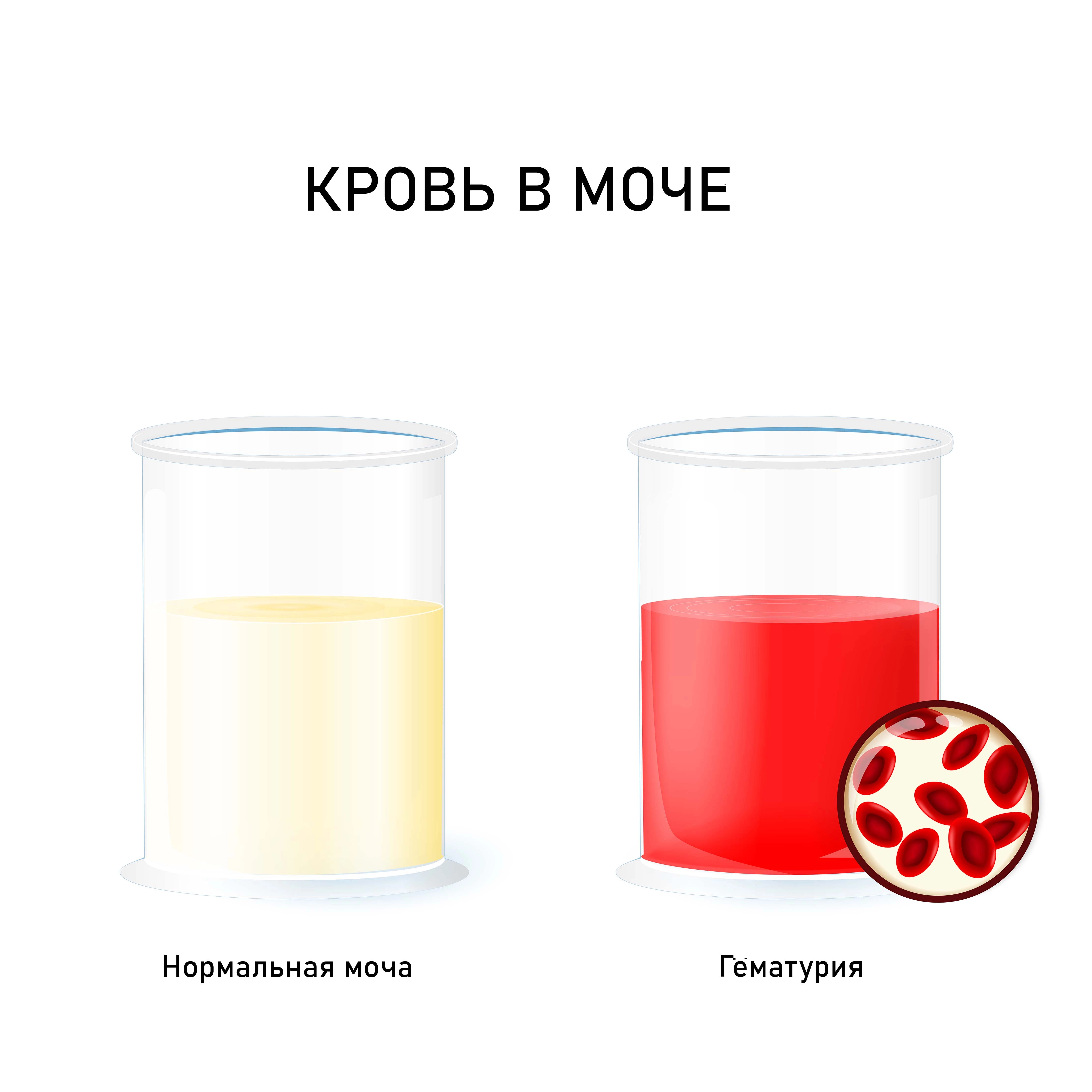 Причины и симптомы крови в моче у мужчин: подробный обзор