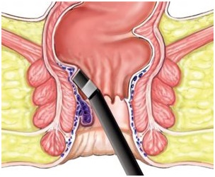 Лазерное лечение анальной трещины